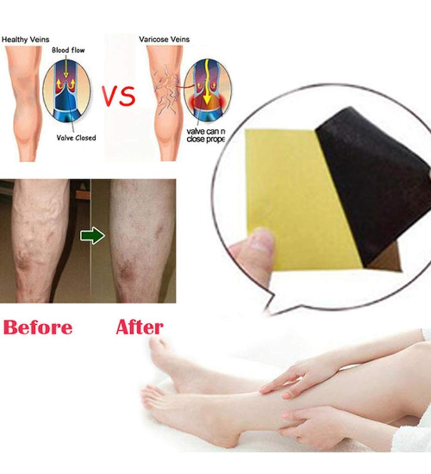 18Pcs Pat Varicose Veins Treatment Plasters - Herbal Medicine for Spider Veins & Vasculitis - Effective Chinese Remedies - Buy Online on GoSupps.com