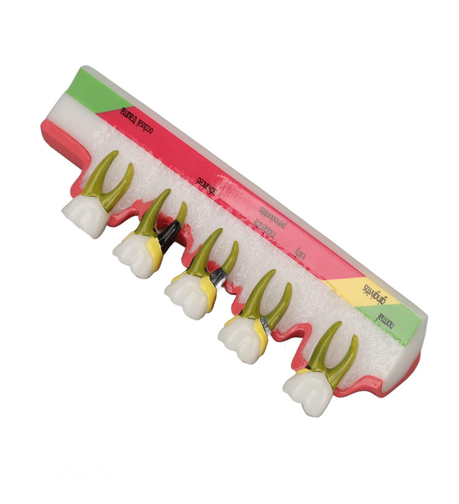 Dental Model for Periodontitis - Realistic Teaching Aid Resin Model for Educational Purposes - Buy Online on GoSupps.com