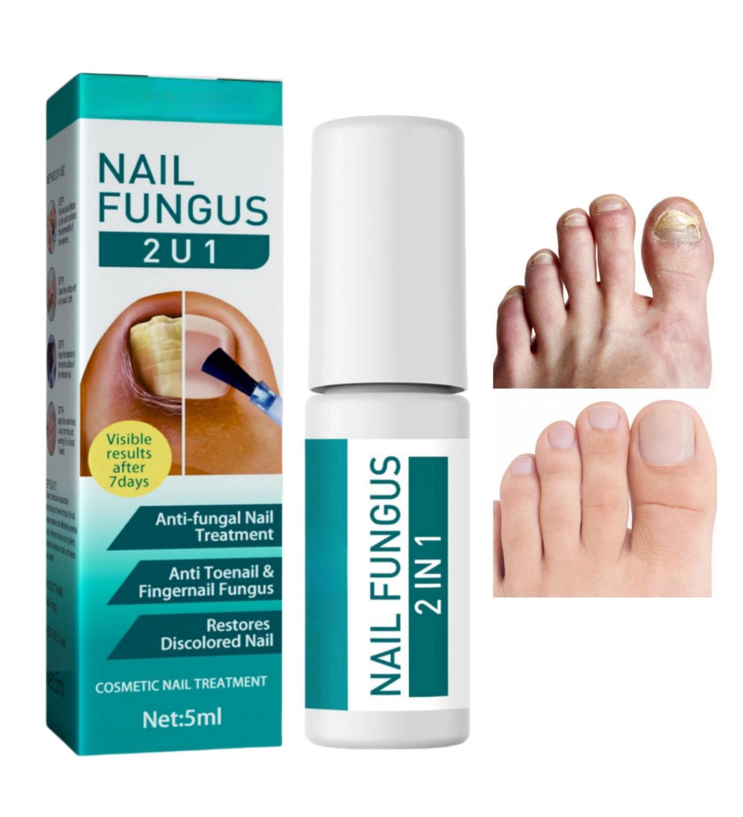 2 IN 1 Fungal Nail Treatment Nail Repair Essence For Toenails Anti Fungal Nail Treatment Toenail Fungus Treatment Nail Fungus Serum For Toenail Nail Fungal Treatment Extra Strength Fast Nail Repair - Buy Online on GoSupps.com