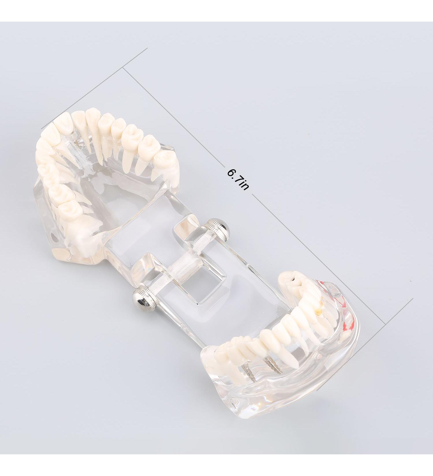 Akozone removable tooth disease model for dental diseases removable for teeth typodont demonstration adults new school programs