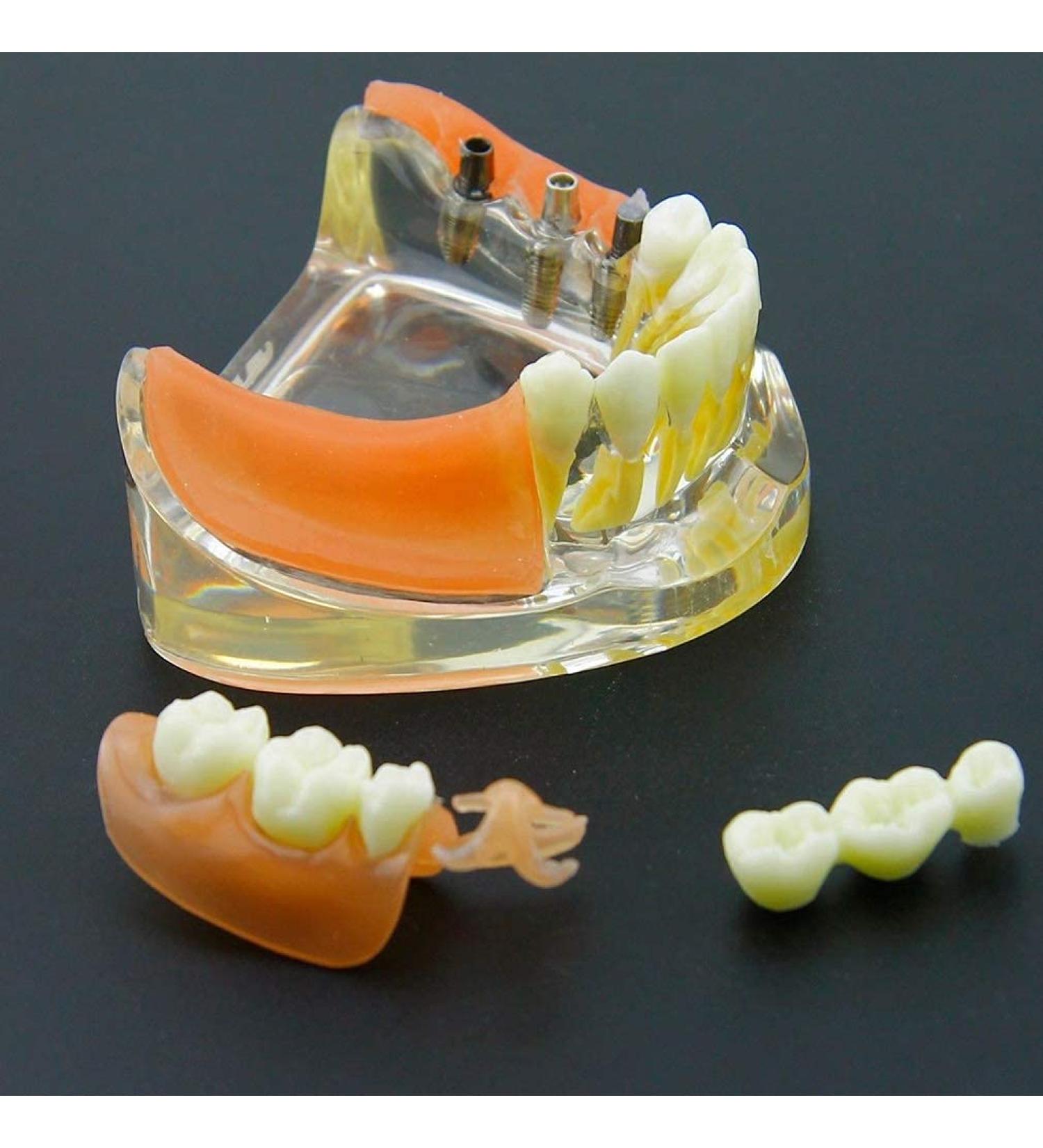 Dental Implant Restoration Model | Removable Bridge & Denture Demo for Teaching & Patient Education - Buy Online on GoSupps.com