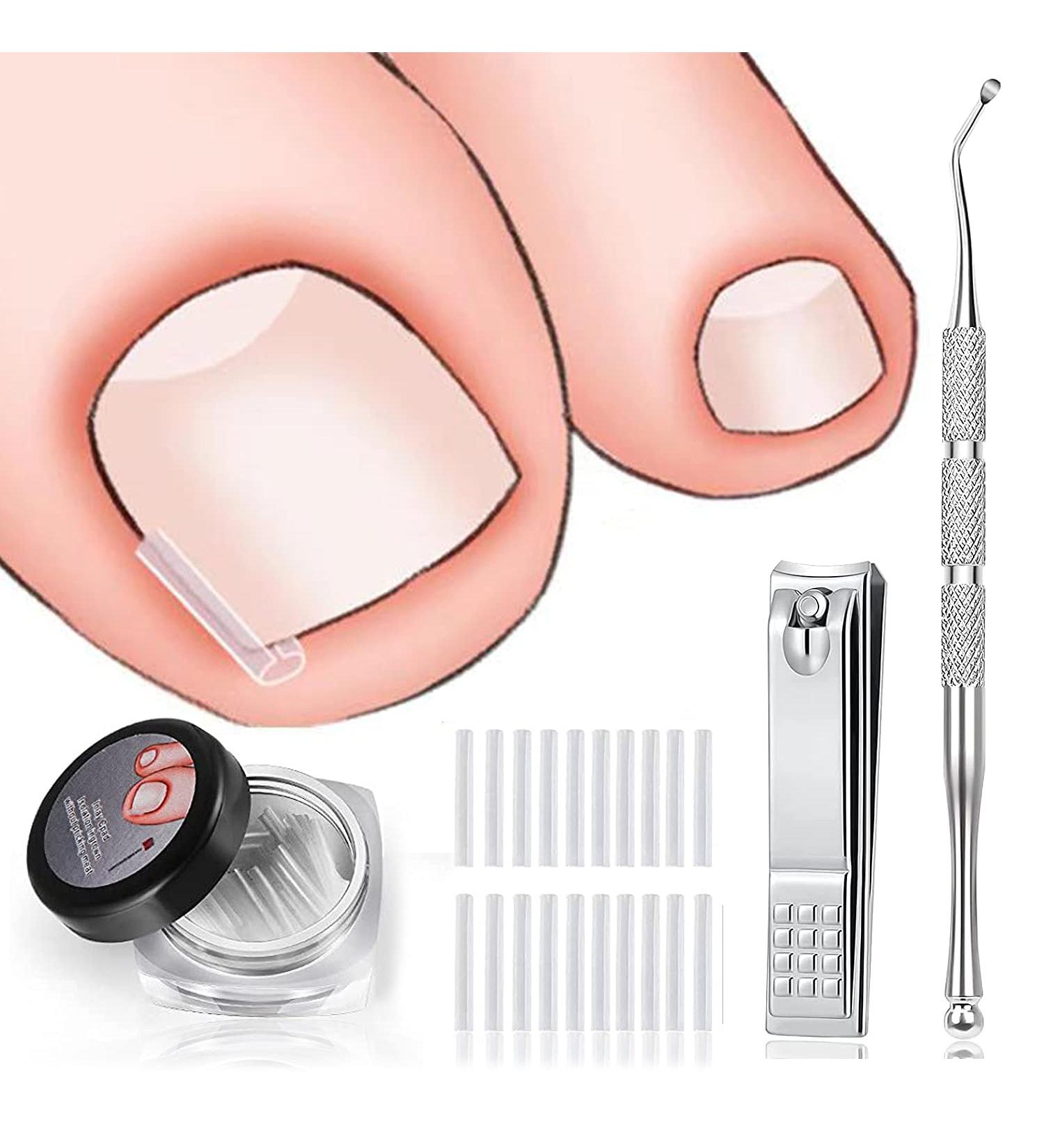 60+2 Pack Ingrown Toenail Treatment Set - Includes Corrector Strips, Lifter, and Nail Clipper - Professional Ingrown Toenail Correction Tool - Buy Online on GoSupps.com