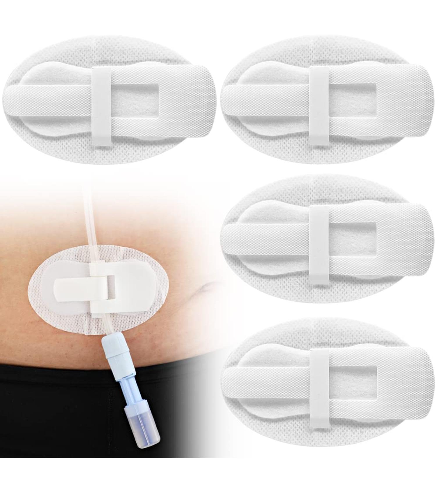 EaseToU Feeding Tube Cover Pack of 5 - Catheter Fixation Pads for J Peg, Foley Drain & Peritoneal Dialysis - Stabilization Device Accessories - Buy Online on GoSupps.com