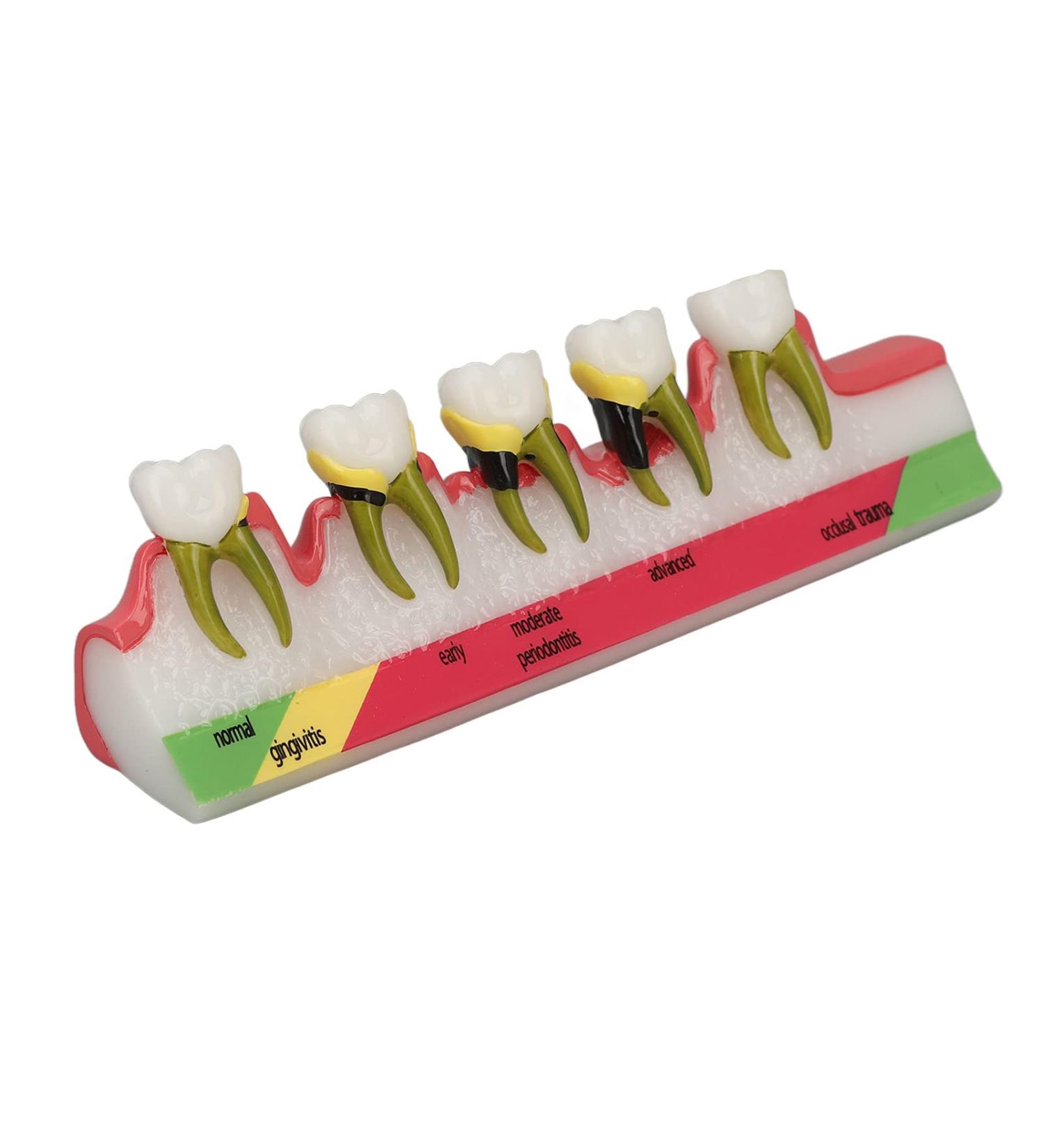 Realistic Dental Periodontitis Model - Study Dental Teeth in Various Stages | Synthetic Resin Educational Tool - Buy Online on GoSupps.com