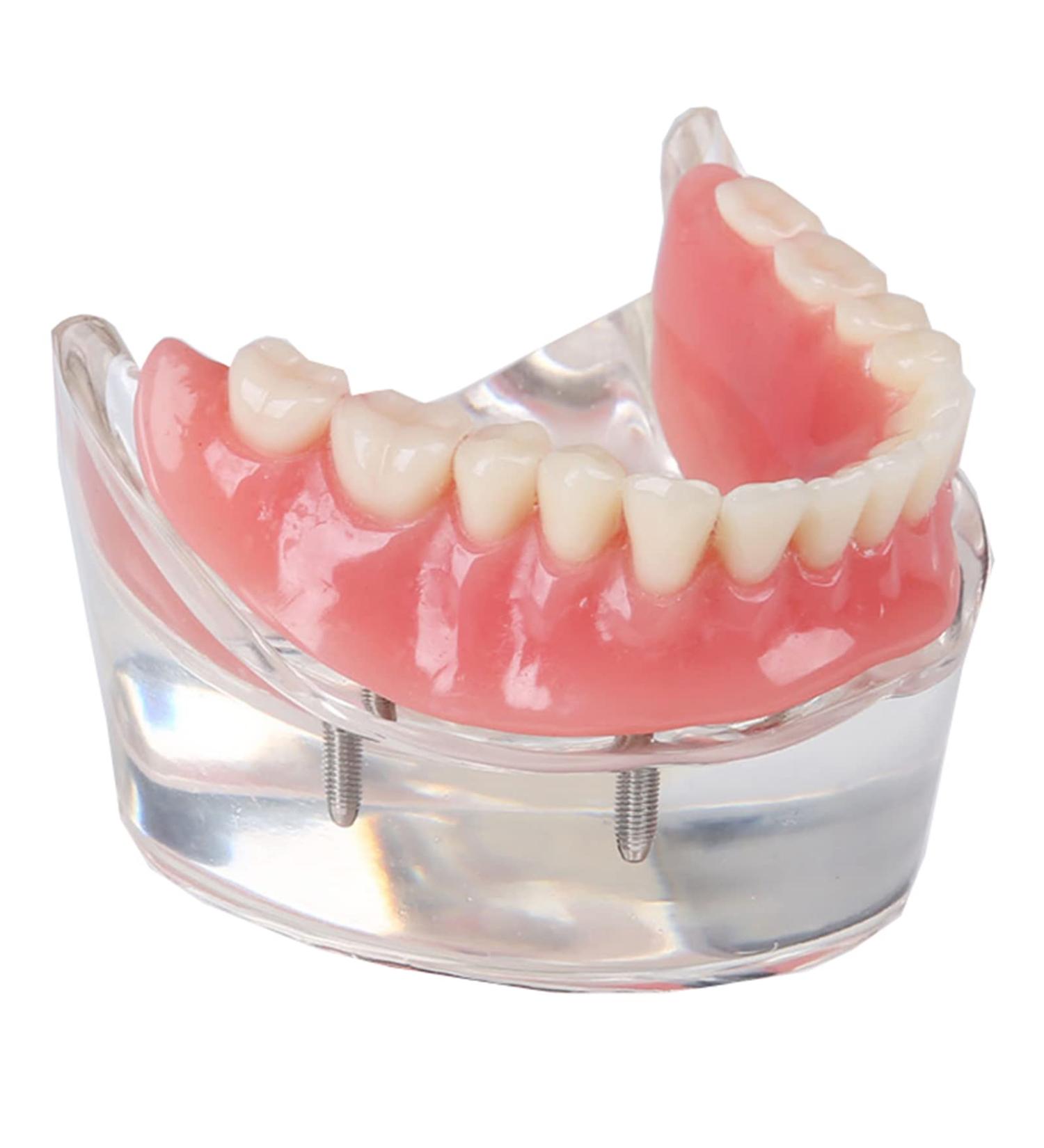 Dental Upper Implant Model - Overdenture Restoration with Transparent Teeth & Soft Gum - Ideal for Education & Study - Buy Online on GoSupps.com