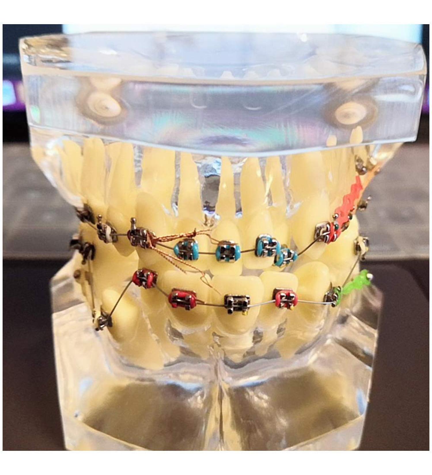 Dytah Dental Painting Model - Orthodontic Treatment with Brackets & Buccal Tube for Malocclusion Study & Lessons - Buy Online on GoSupps.com