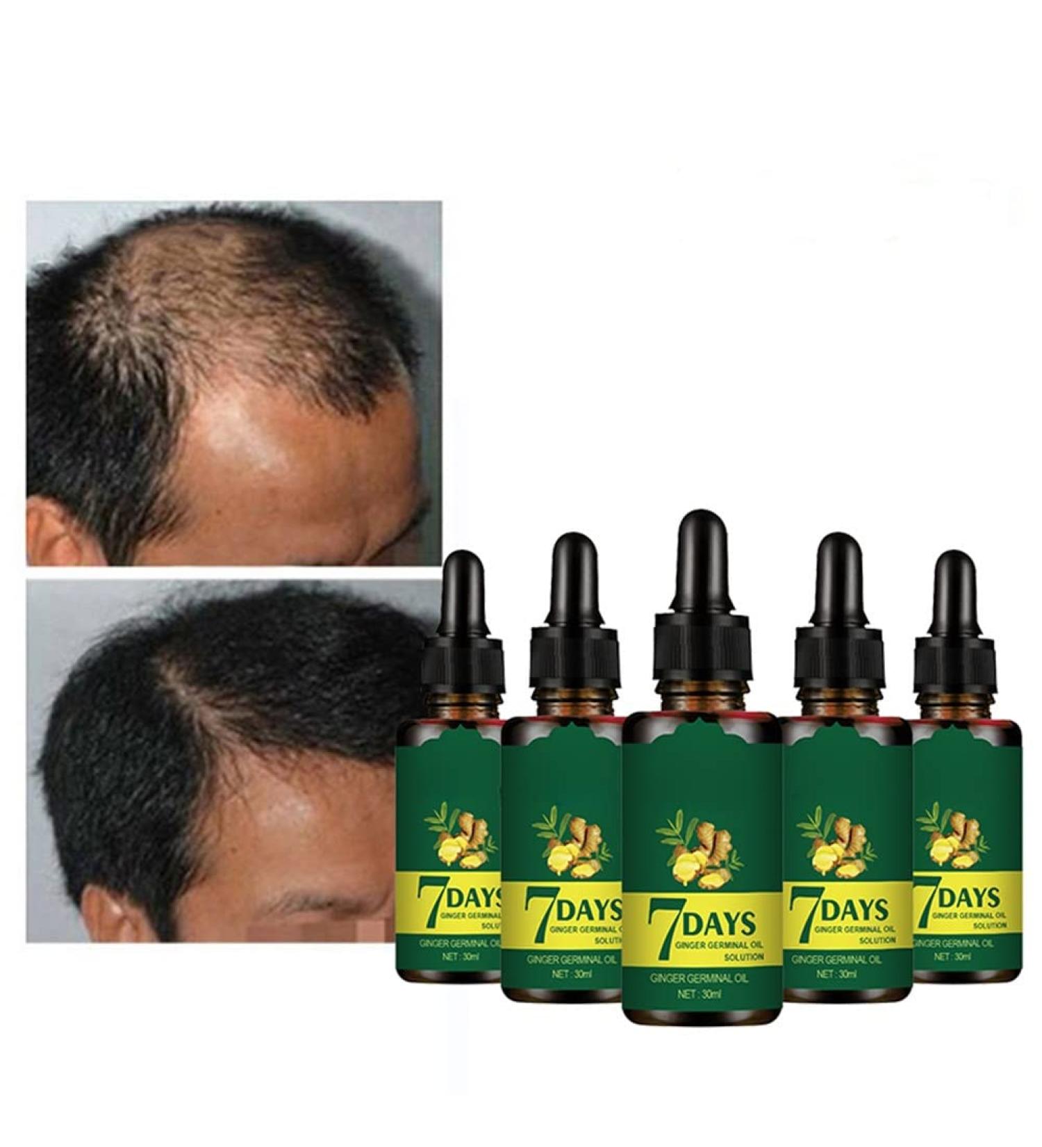 Hair Growth Serum Ginger Germinal Oil Anti Hair Loss Hair Serum Hair Loss and Thinning Hair Treatment Promotes Thicker Hair Growth - Buy Online on GoSupps.com