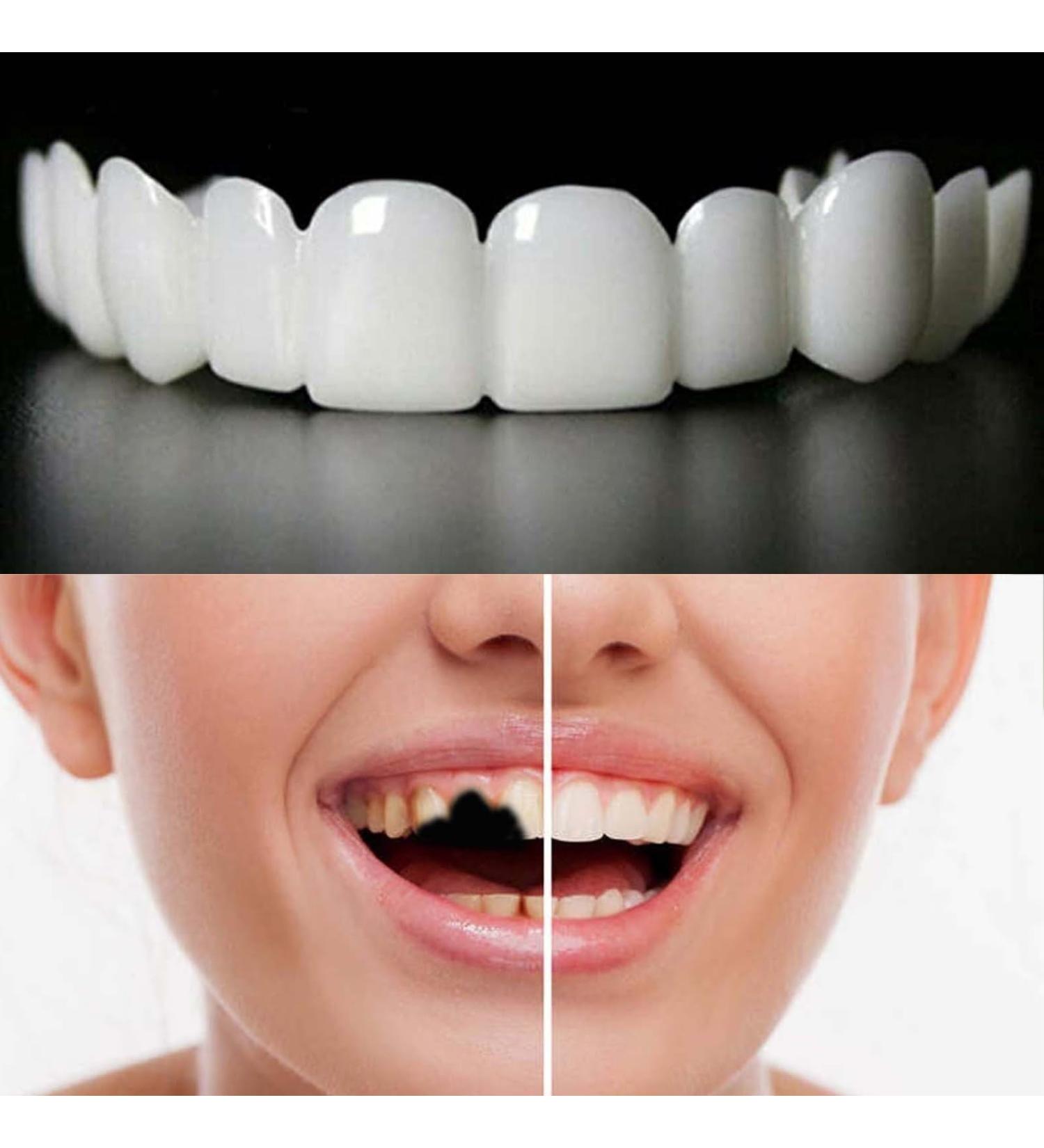 2 Pairs Adjustable Confident Smile Dental Aligners for Men & Women - White | Best International Shipping - Buy Online on GoSupps.com