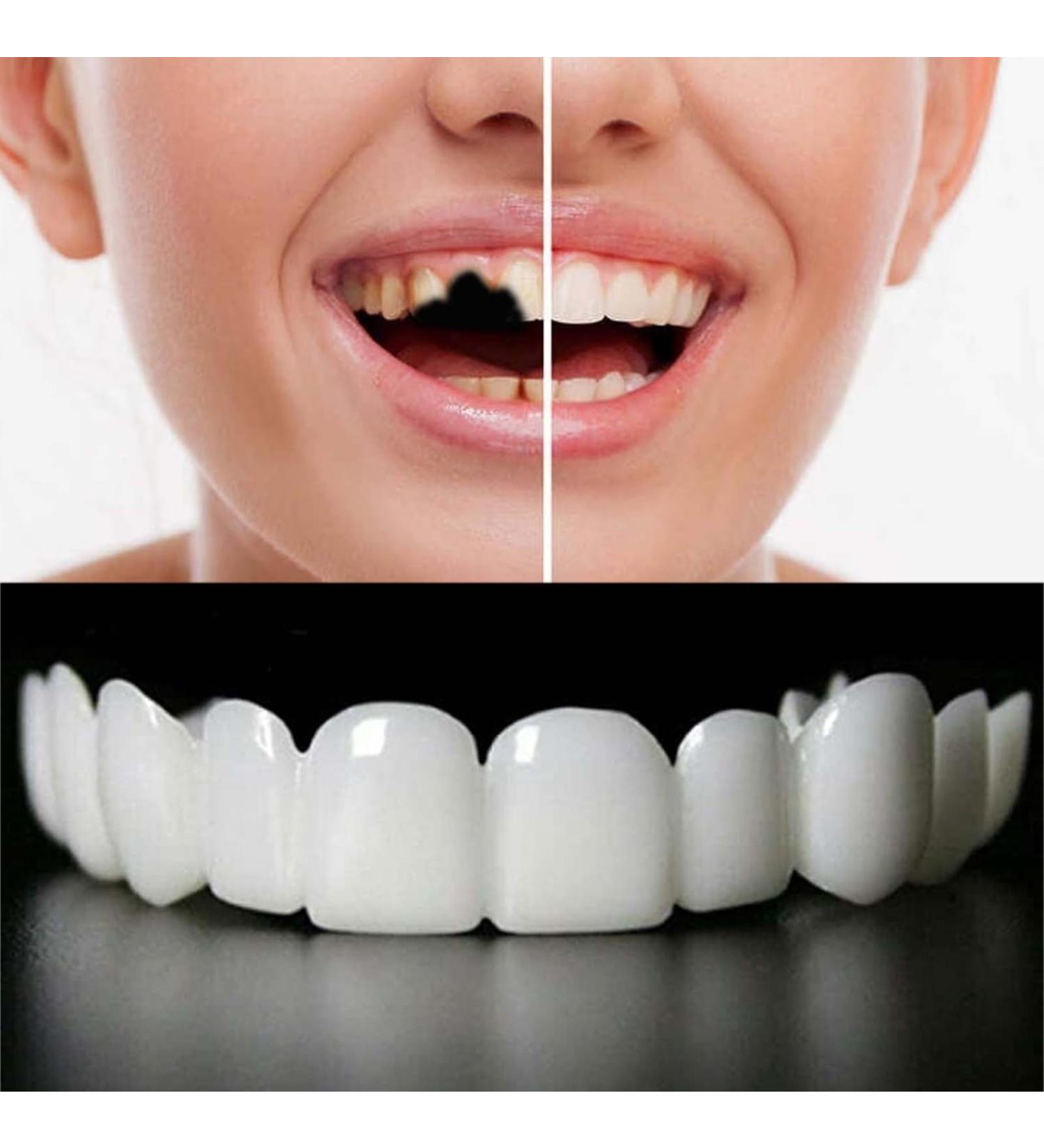2 Pairs Regain Beautiful Smile for Men and Women Temporarily Adjustable(White) - Buy Online on GoSupps.com