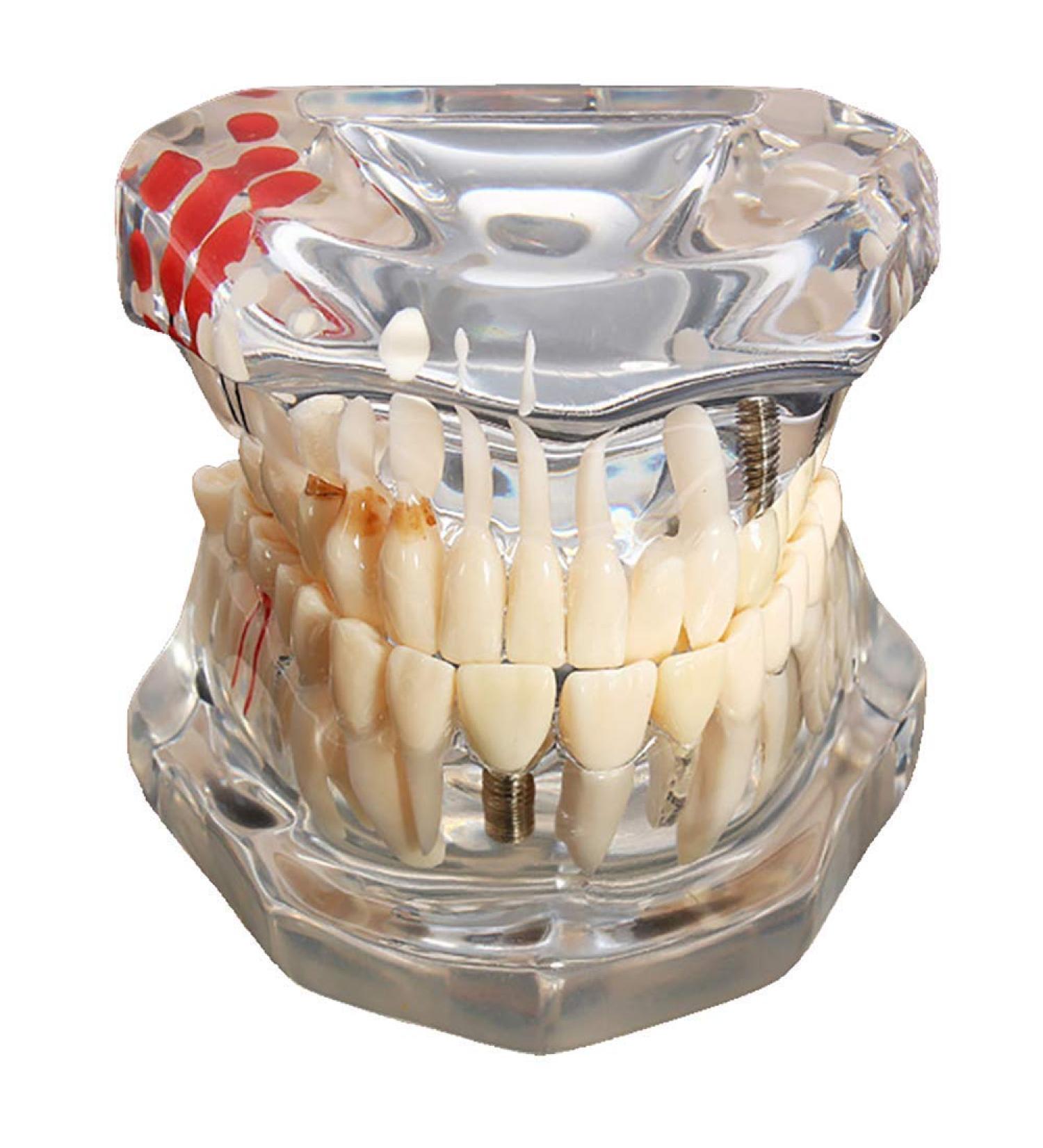 ERNZI Dental Implant Disease Model with Restoration Bridge - Ideal for Dental Research & Education - Buy Online on GoSupps.com