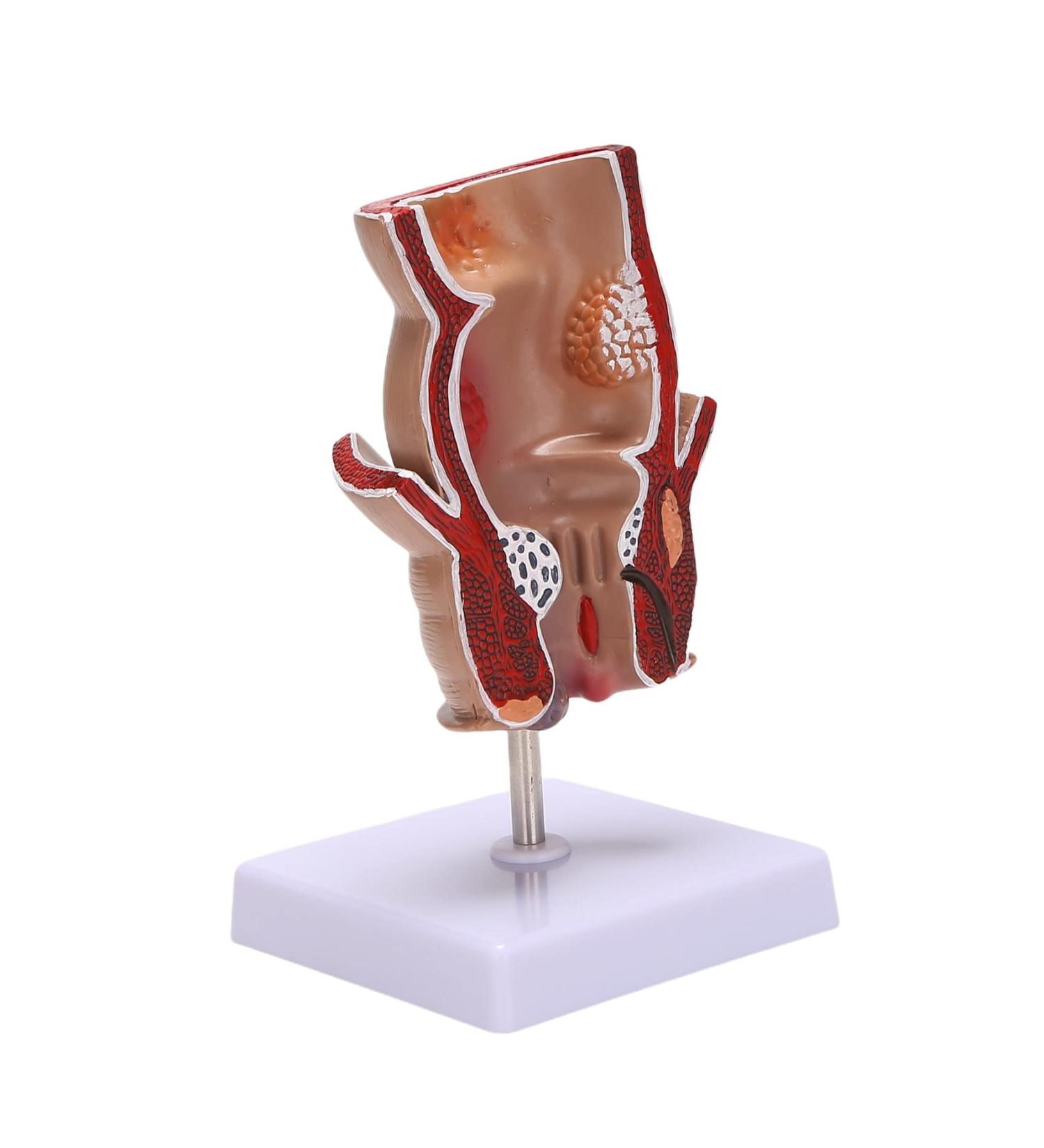 Anatomy Model: Human Rectal Lesion Fistula & Fissure Pathology - Ideal for Teaching | International Shipping - Buy Online on GoSupps.com