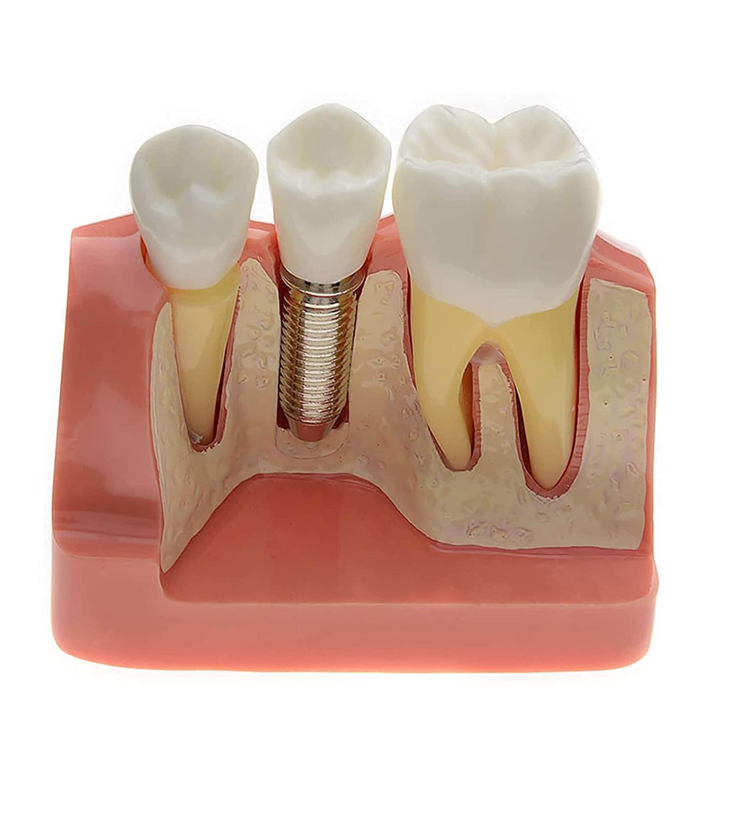 Samnuerly Dental Implant Model - 4-Way Analysis & Crown Bridge Demo for Training | International Shipping Available - Buy Online on GoSupps.com