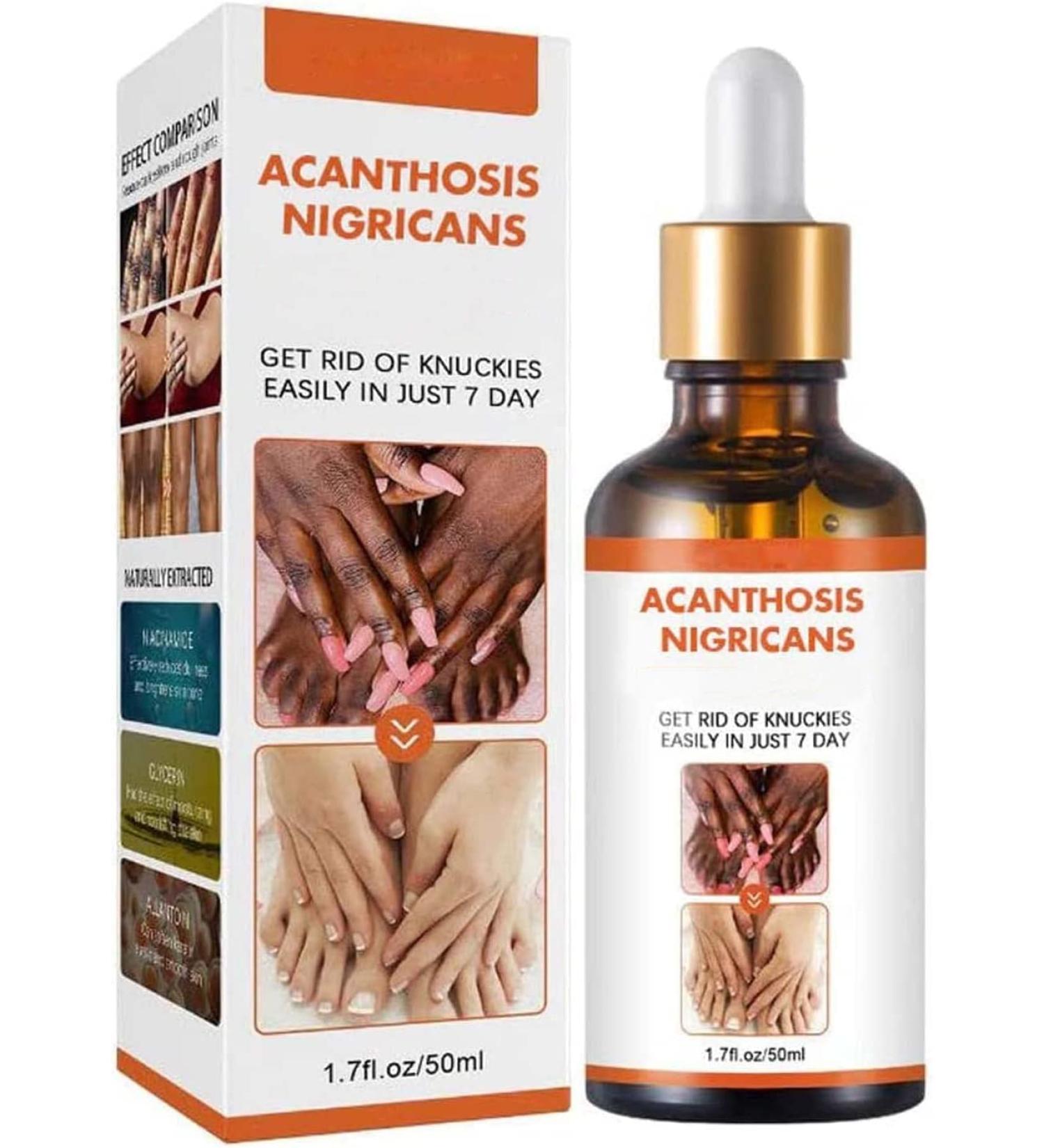 Acanthosis Nigricans Huile de th rapie pour corriger les taches sombres traitement de l'acanthose nigricans limine les taches sombres pour claircir le corps et la peau noire (1 pi ce) 1 pi ce. - Buy Online on GoSupps.com