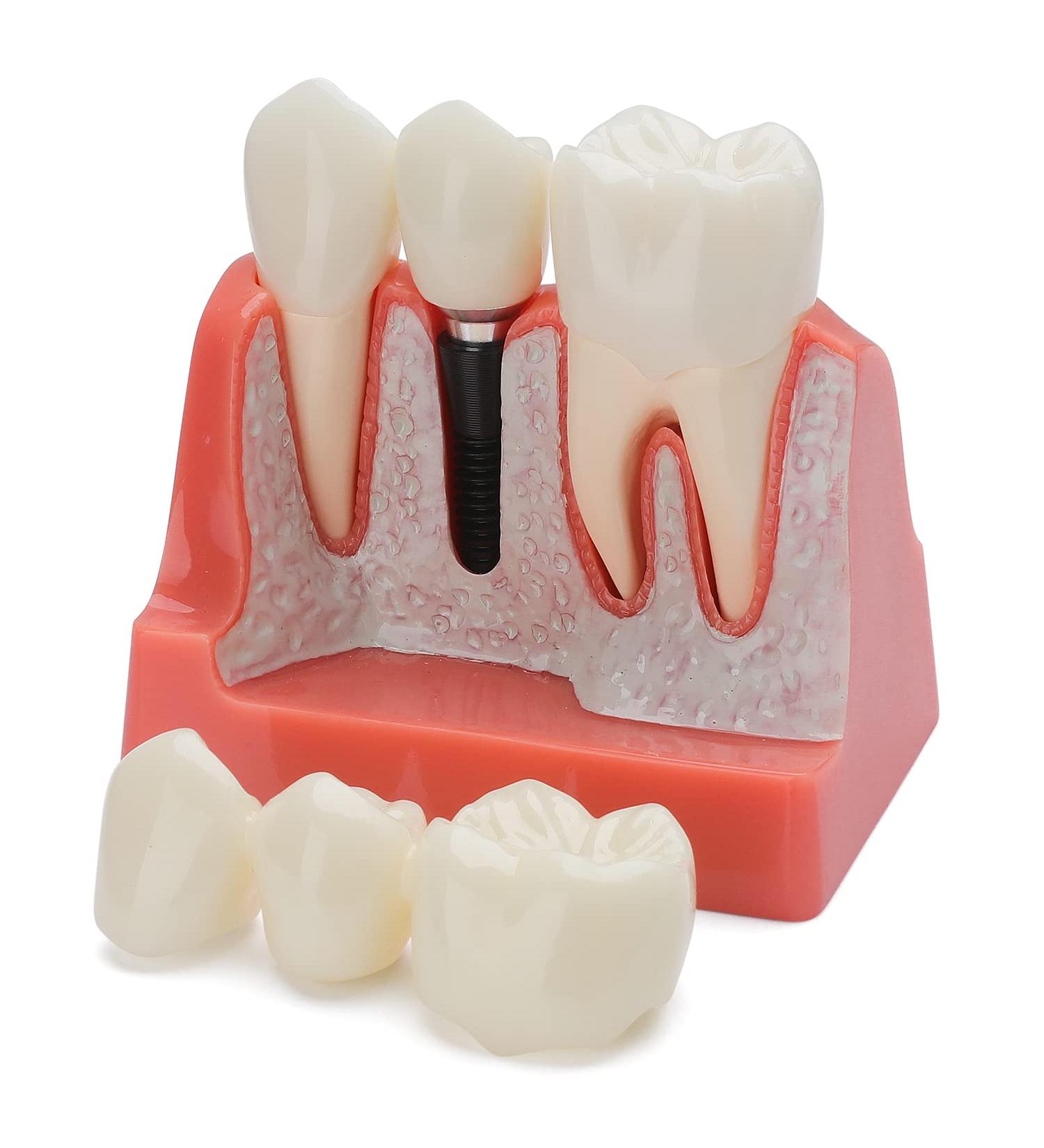 Dental Implant Model - 4 Times Removable Crown Bridge | Educational Teeth Model for Learning & Analysis - Buy Online on GoSupps.com