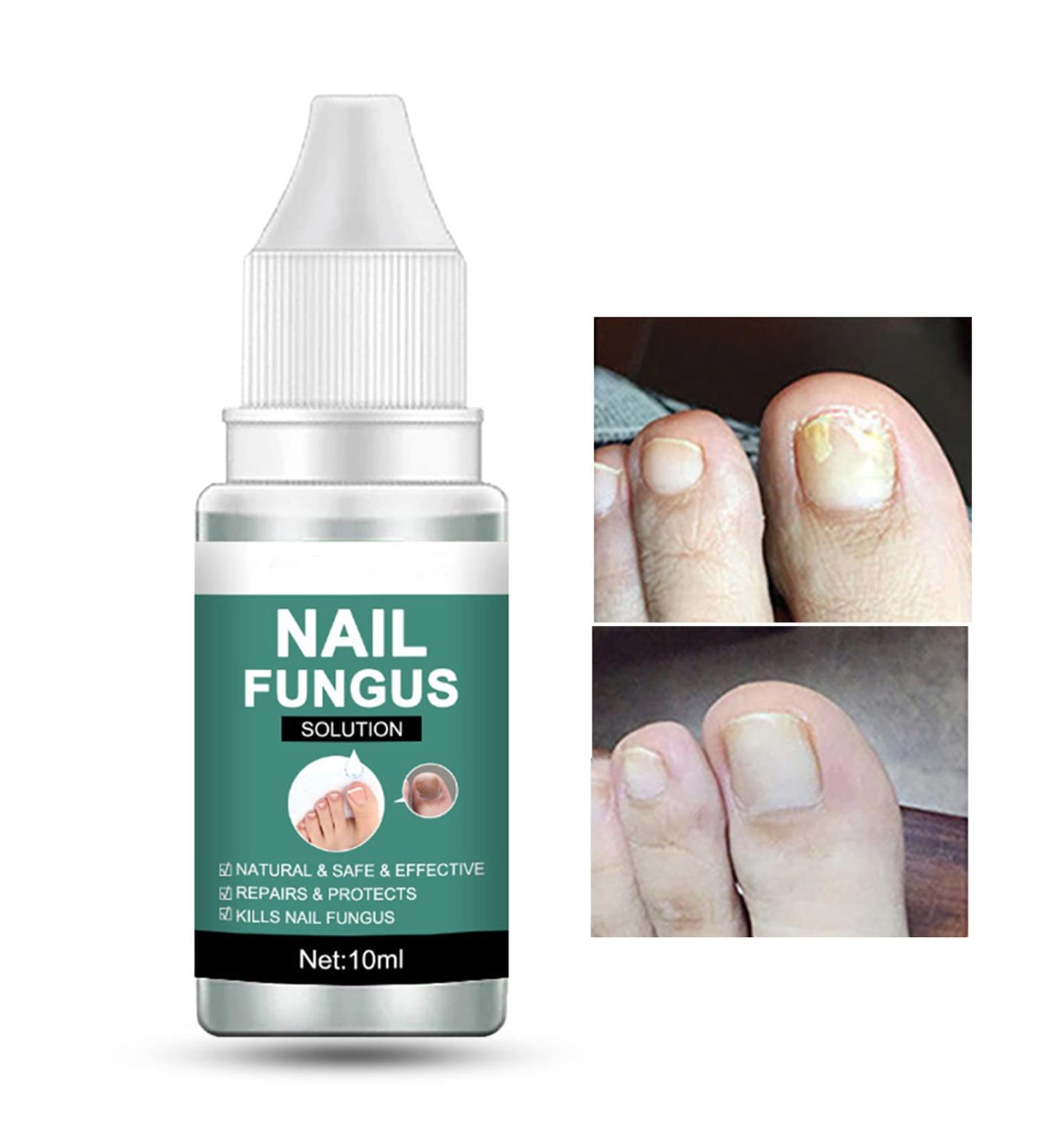 Fungal Nail Treatment - Extra Strong Solution for Toenail Fungus & Ingrown Toenails (10ML) - Buy Online on GoSupps.com