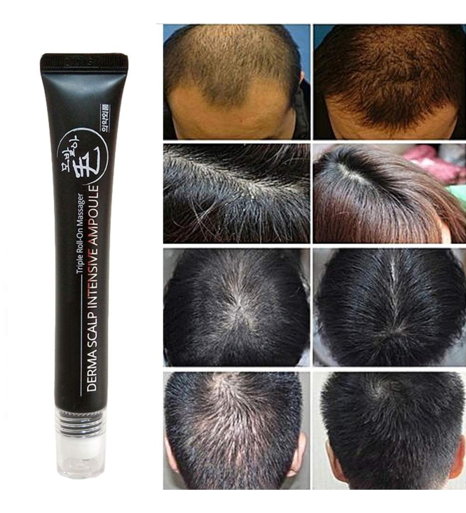 Symeas Hair Regrowth Serum Derma Scalp Intensive Ampoule Triple Roll Massager Scalp Revitalizer Anti Hair Loss Thinning Balding Hair Treatment Essential Oil - Buy Online on GoSupps.com