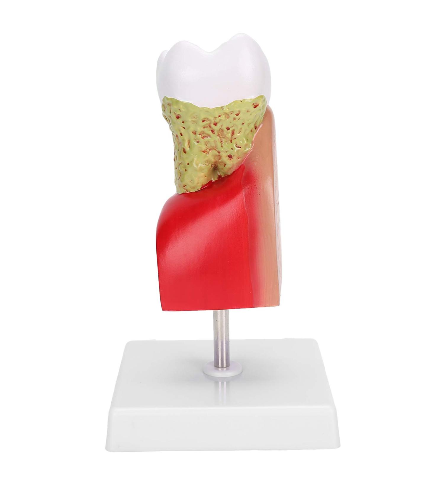 Verdant Touch Tooth Model - Dental Caries Teaching & Training Aid for Patient Education - International Shipping - Buy Online on GoSupps.com