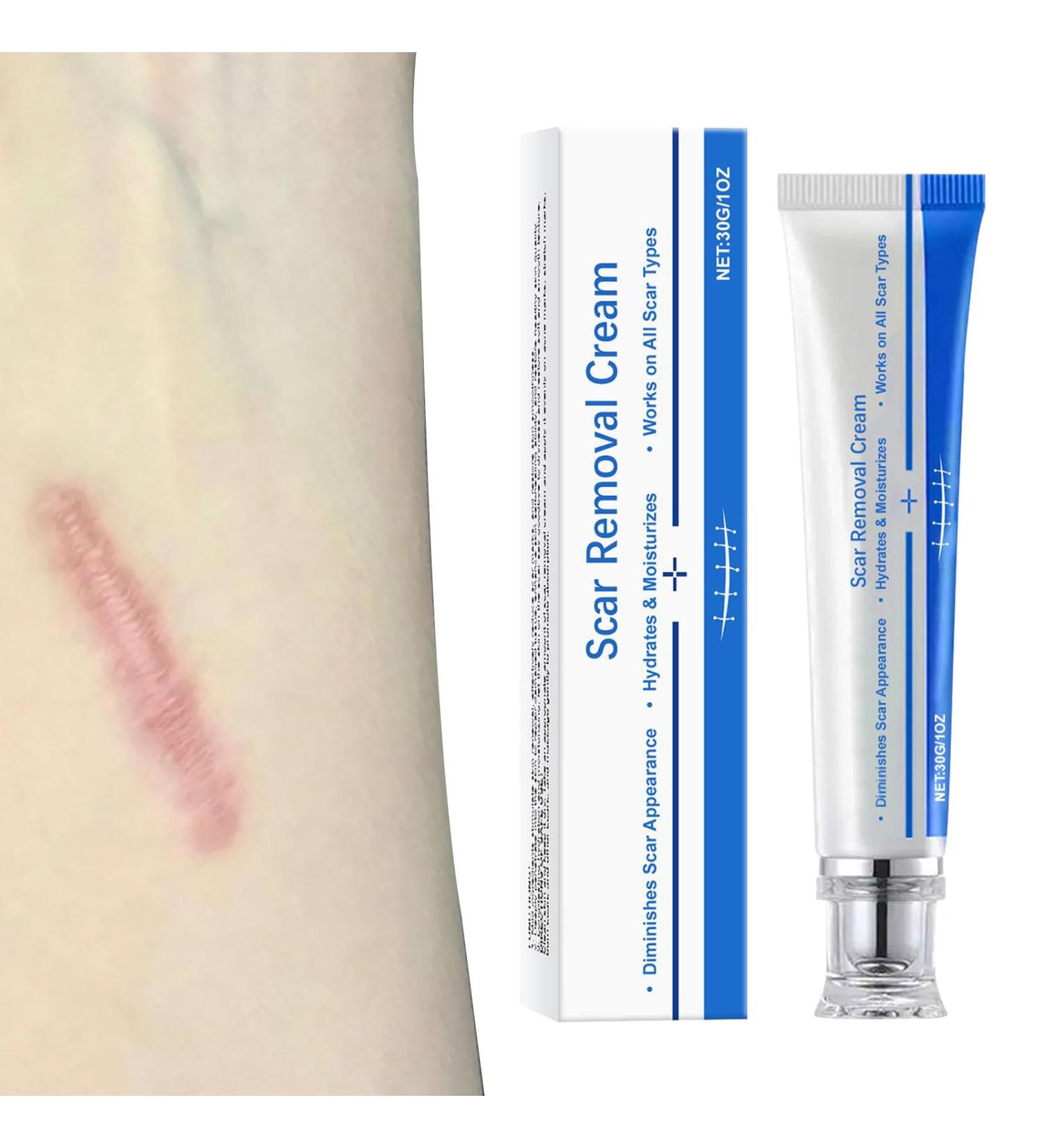 mother Scar ointment after op scar ointment for old scars versatile scar cream for surgical scars caesarean section acne scars burns keloids 30 g - Buy Online on GoSupps.com