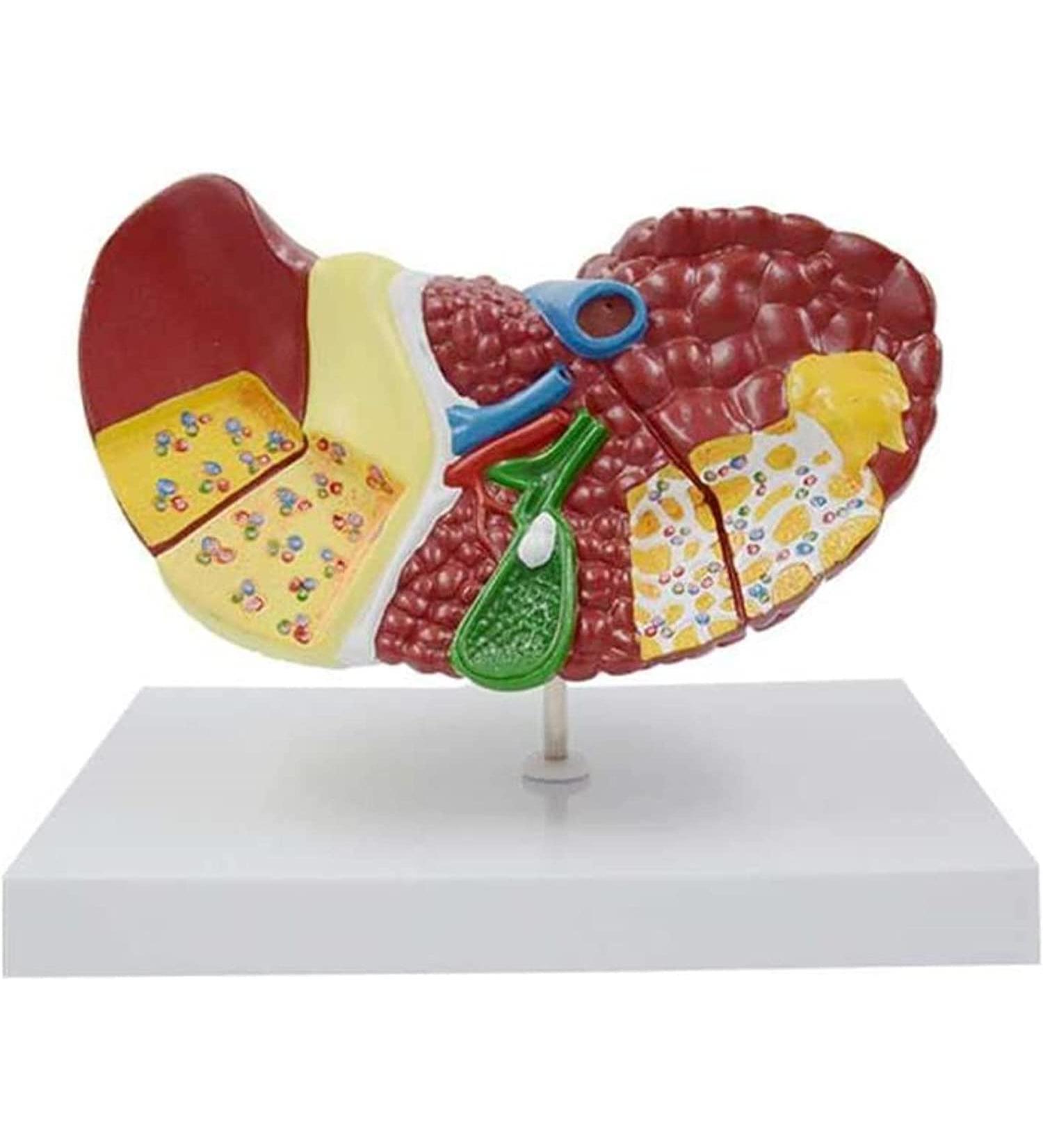 Liver Damage ical Model Liver Pathology Models Teaching Aids - 22.5 * 17 * 16CM - Buy Online on GoSupps.com