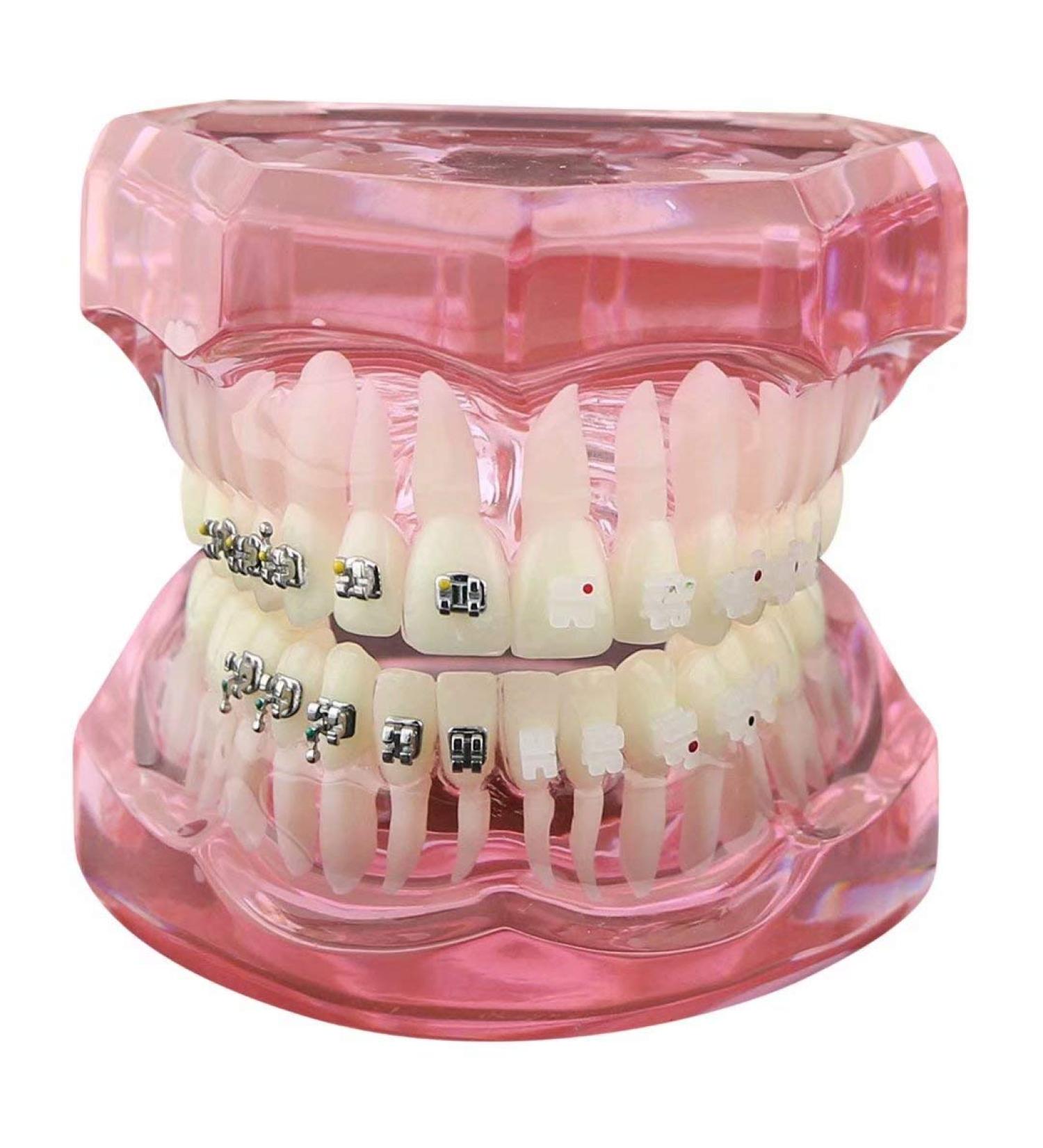 Orthodontics Model with Ceramic & Metal Brackets - Educational Teach Model for Dentists | Global Shipping - Buy Online on GoSupps.com