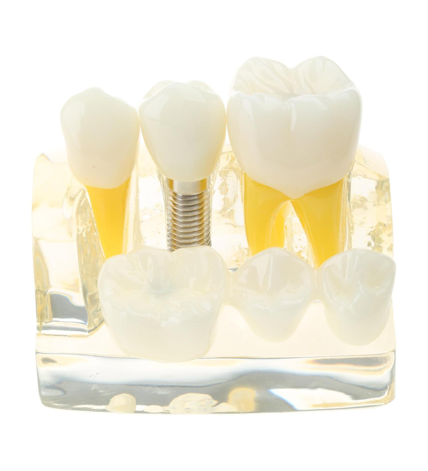 Implant Model Removable Bridge - Educational Teeth Model for Dental Studies | Perfect for Demonstration Classes - Buy Online on GoSupps.com
