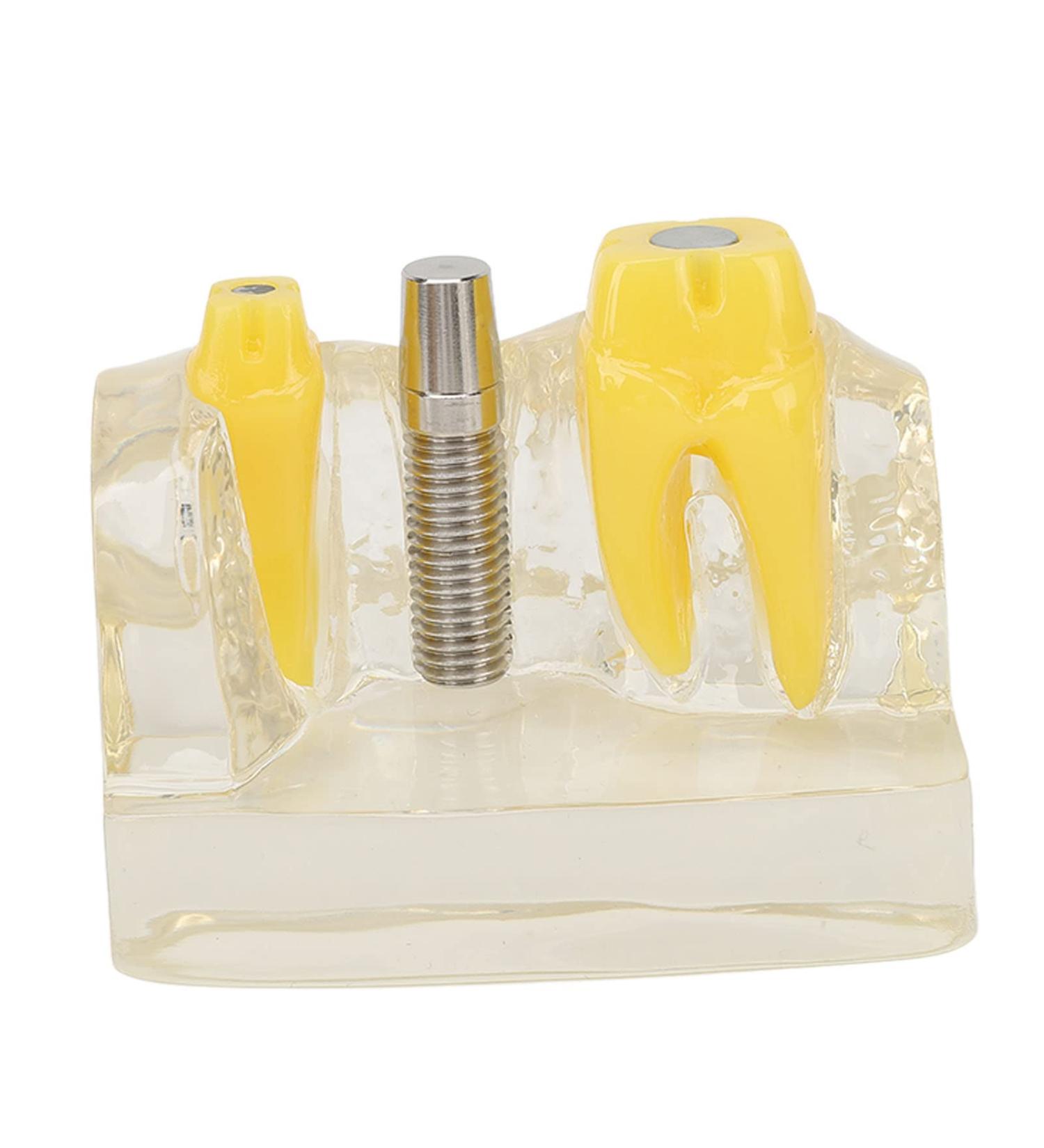 Verdant Touch Dental Implant Model | Transparent Dental Implant for Teaching & Research | International Shipping - Buy Online on GoSupps.com