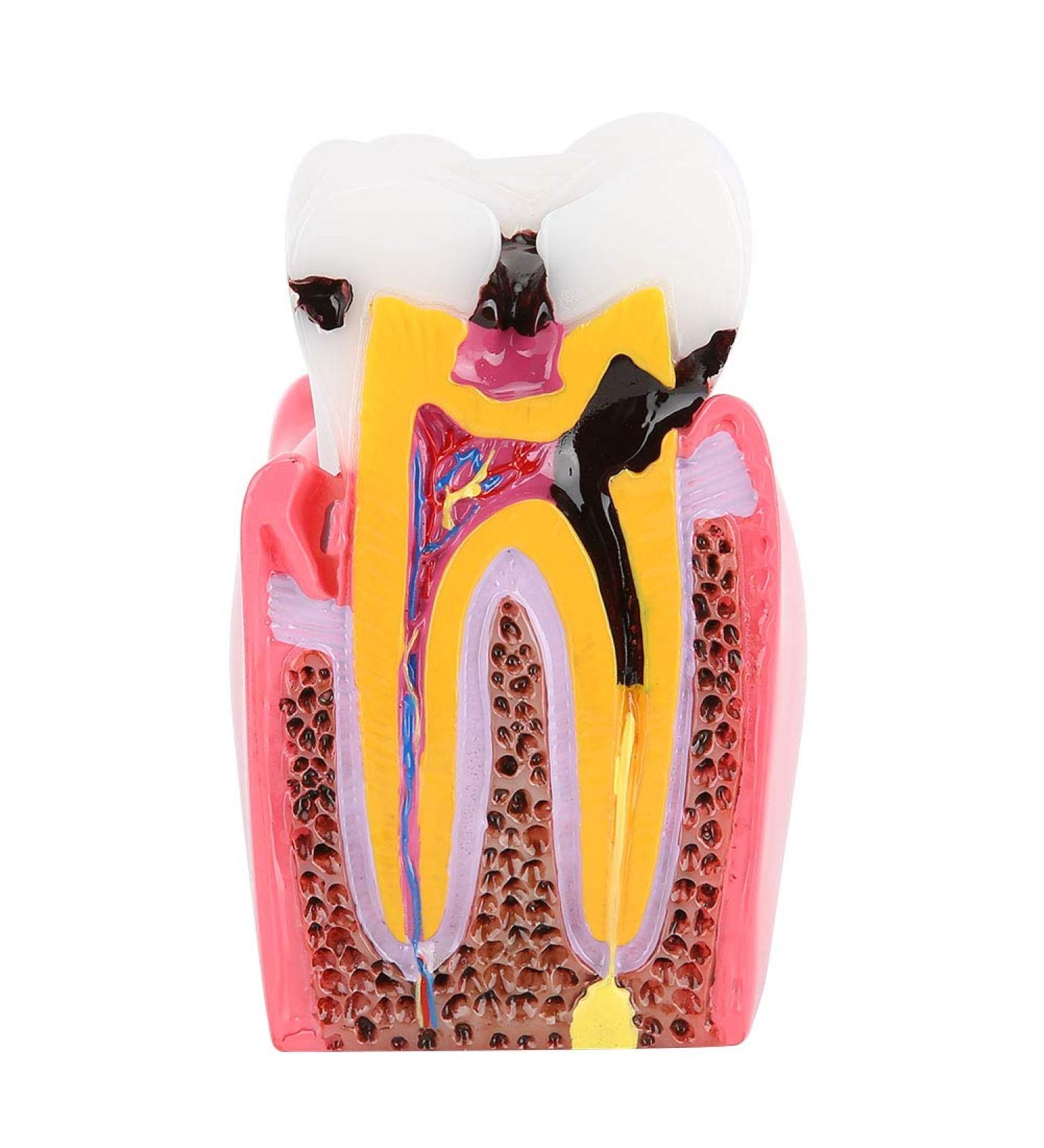 High-Quality Dental Prosthesis Model for Oral Care | International Shipping Available - Buy Online on GoSupps.com