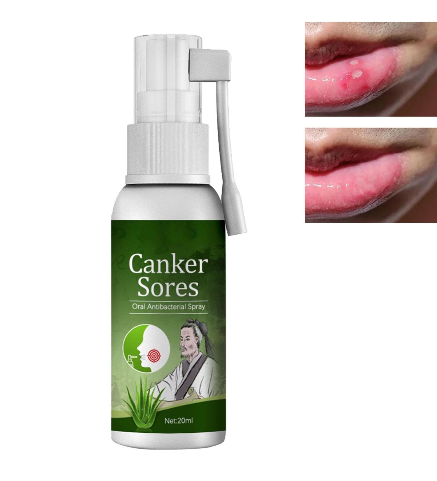 Spray de Soulagement Ulc res Spray Ulc res de la Bouche Spray de Soulagement des Aphtes Spray Pour Ulceres Buccaux Soulagement De La Douleur Buccale Spray Traitement des Ulc res - Buy Online on GoSupps.com