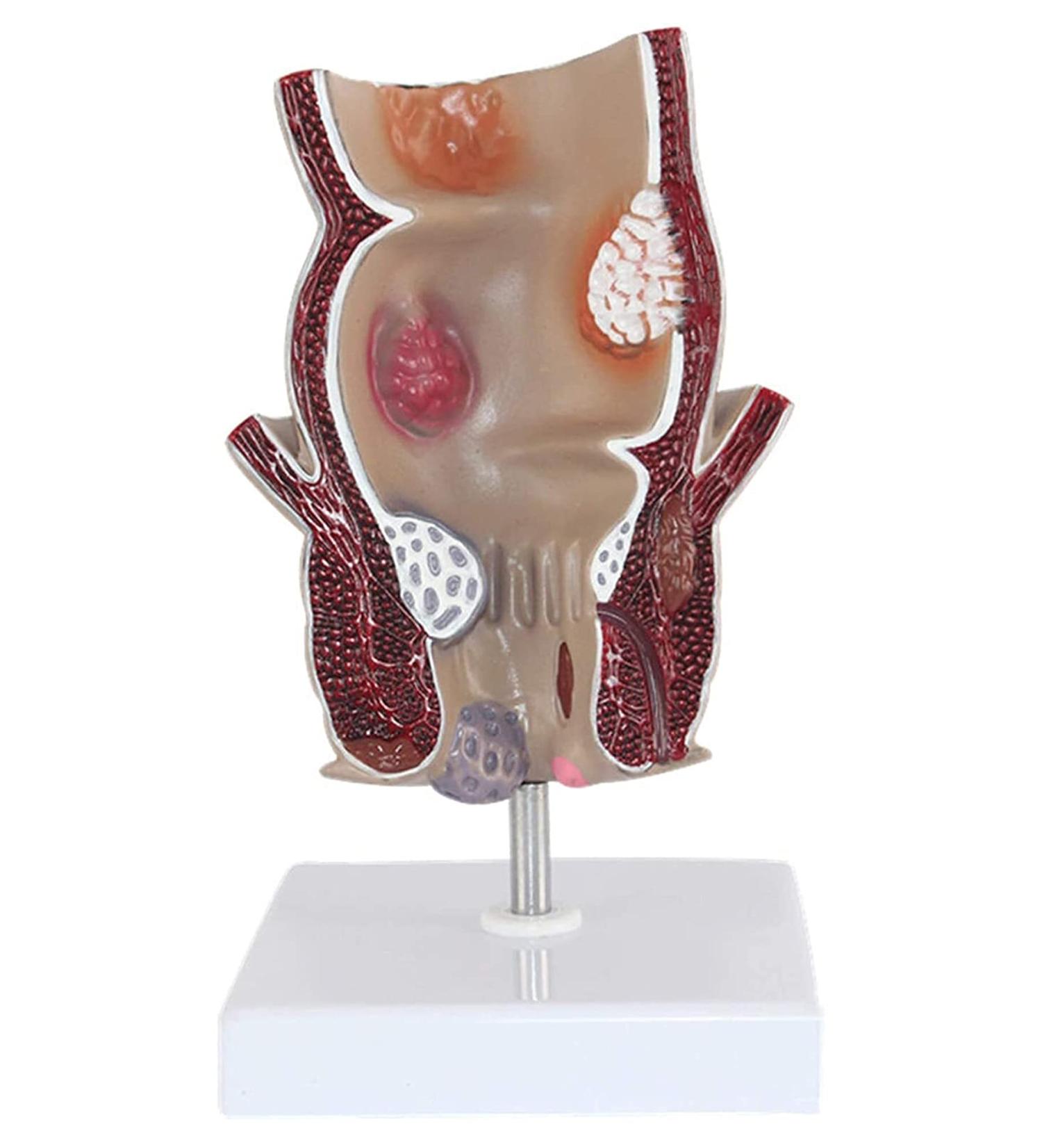 Medical Science Rectum Fissure Lesion Model 5X Human Pathology Model Hemorrhoid Anal Fistula Medical Organ Model - Buy Online on GoSupps.com