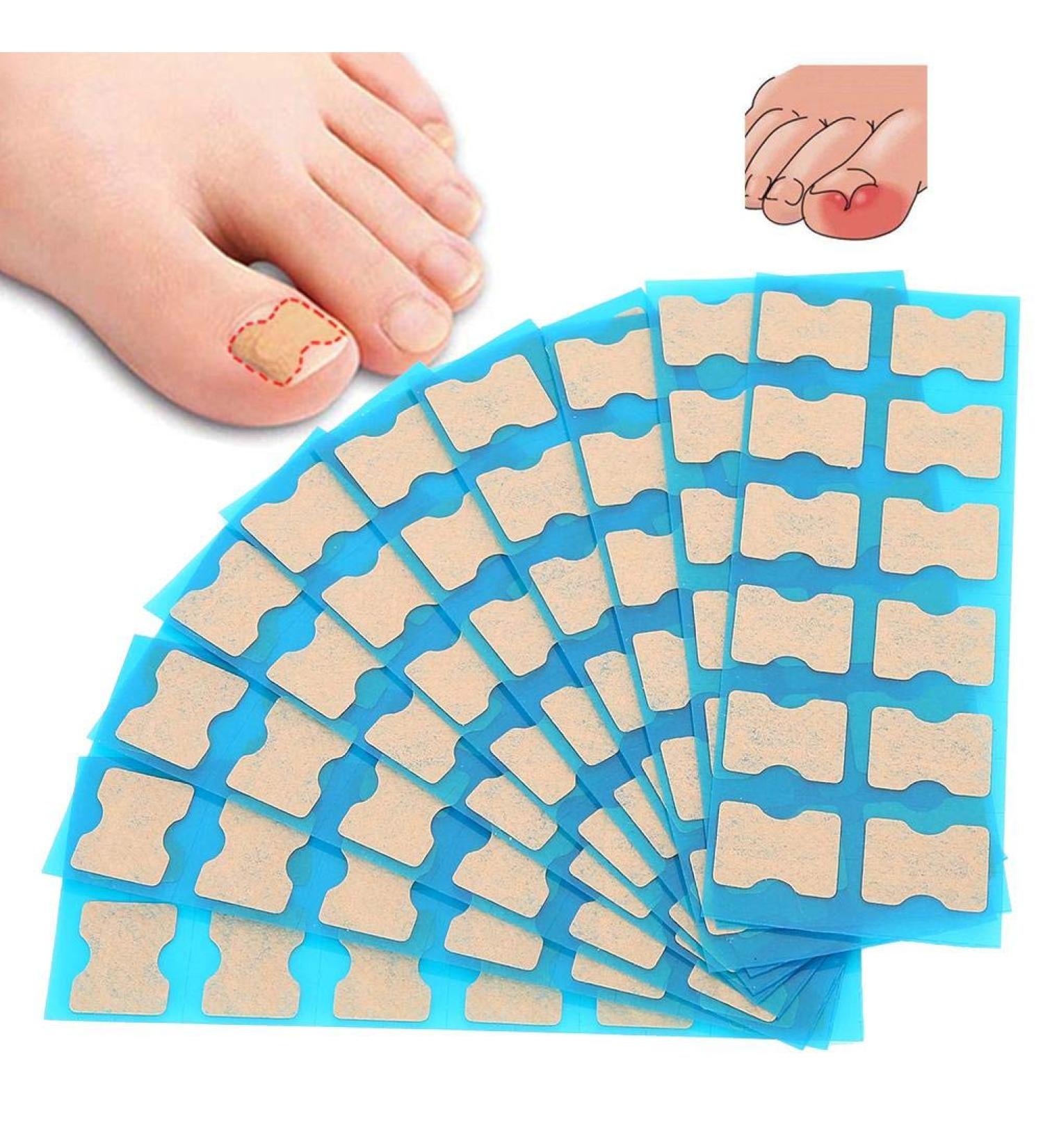 Ingrown Toenail Correction Patch - Paronychia Corrector Treatment - Glue-free Toe Nail File - 4 Sizes - Foot Care Pedicure Tool - Buy Online on GoSupps.com