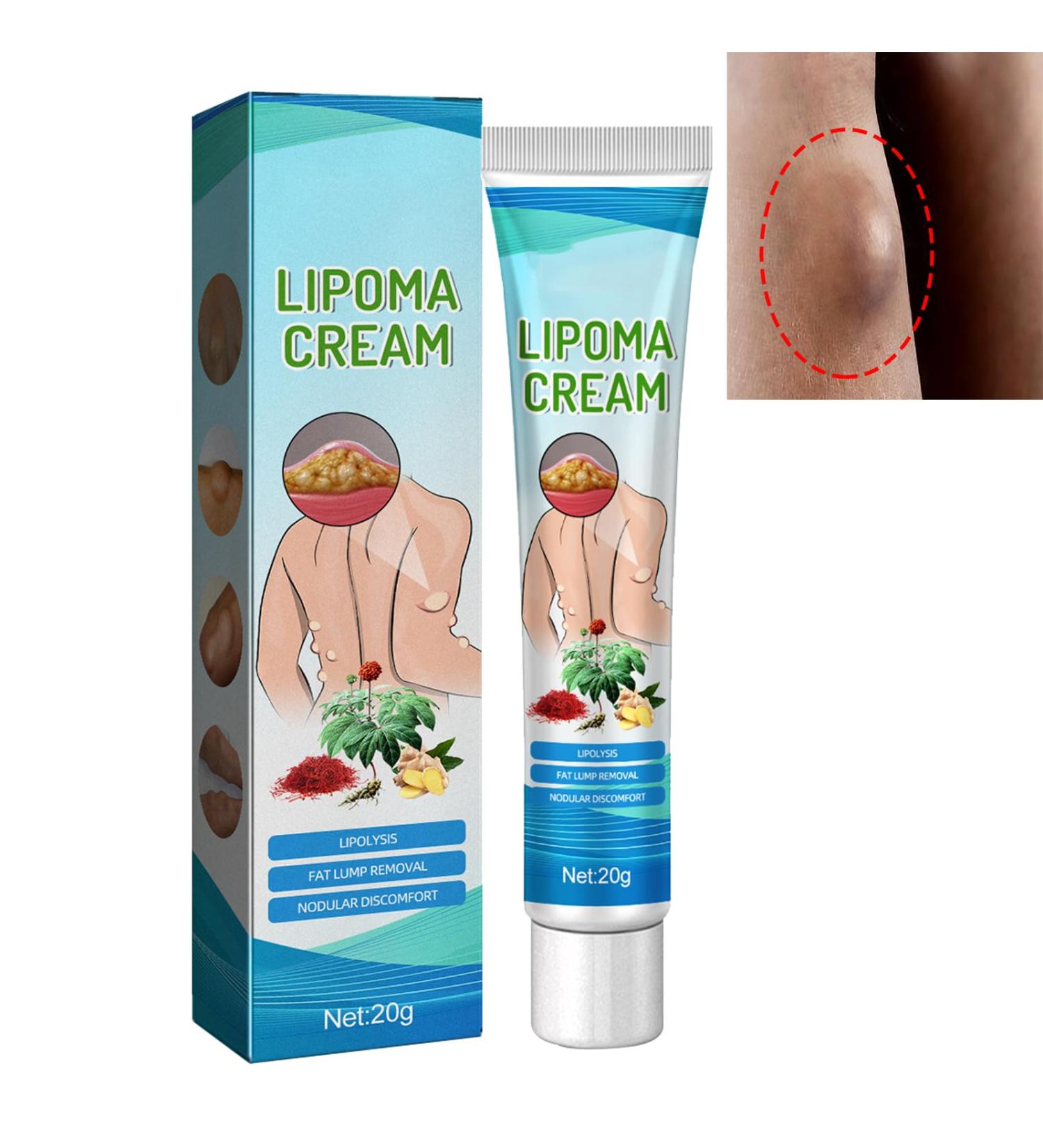Lipoma Care Cream Lipoma Removal Cream Lipoma Elimination Cream Lipoma Creams Lump Free Cream Herbal Lipoma Removal Balm Cream Get Rid of Your Fatty Lipoma Lumps Herbal Internally Lipoma Removal Balm - Buy Online on GoSupps.com