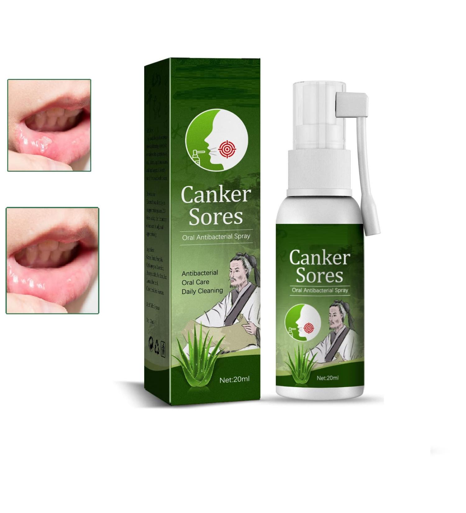 Ulcer Relief Herbal Mouth Spray 20ml - Antiviral Treatment for Canker Sores, Bad Breath, and Dry Mouth - Buy Online on GoSupps.com