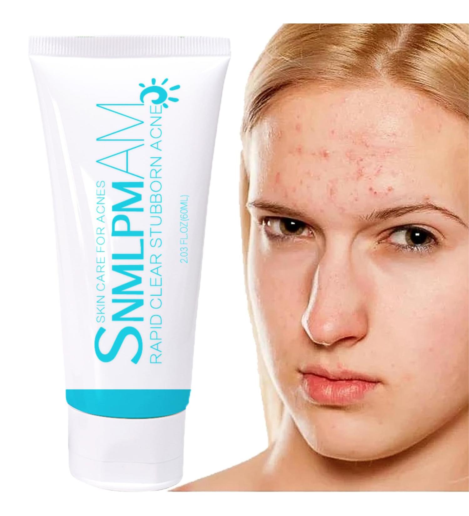 Face Acne Cream Anti Acne Face Cream Anti Acne Removal Cream Facial Smooth Care Acne Moisturiser Dark Spot Remover for Face and Body Acne Moisturiser - Spot Cream for Teenagers Women Men - Buy Online on GoSupps.com