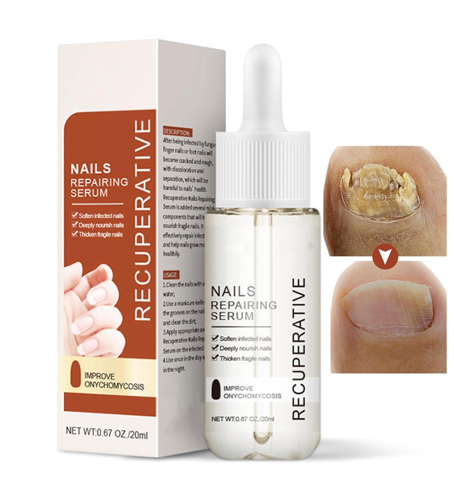 Nail Growth and Strengthening Serum 20ml Nails Repair Serum Fungal Nail Treatment for Toenail Extra Strong Toenail Growth Treatment for Repairing Damaged and Discolored Nails Improve Onychomycosis - Buy Online on GoSupps.com