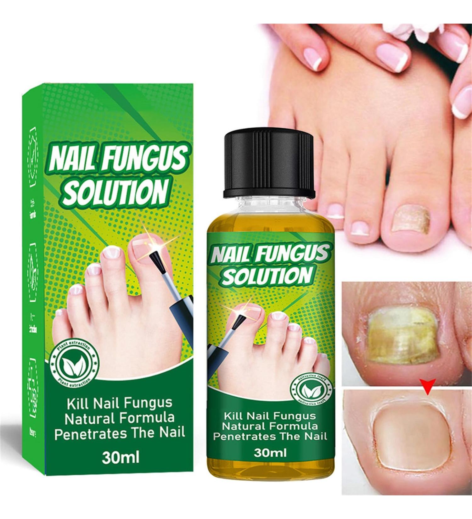 ERFD Toenail fungus care Fungal Nail Cure for Toenails Extra Strong 30ml Anti Fungal Toe Nails Treatment - Buy Online on GoSupps.com