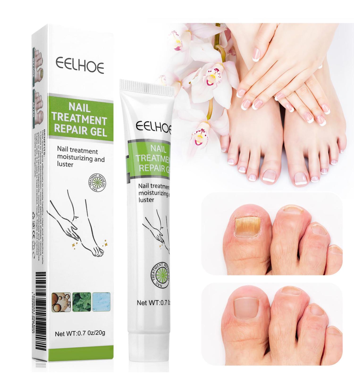 Floepx Nail Repair Gel - 2 PCs Nail Care Treatment for Cracked Rough Nails & Discoloration - Protect & Repair Your Toenails - Buy Online on GoSupps.com