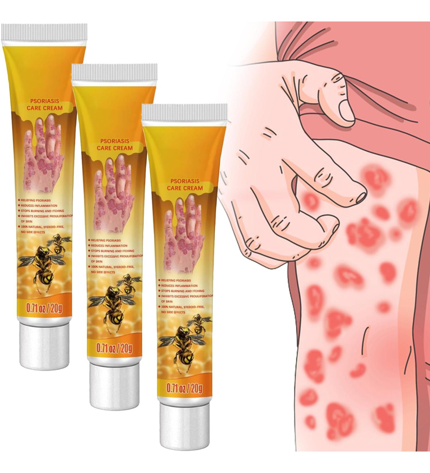 Bee Venom Psoriasis Treatment Cream - Soothing & Moisturizing Formula from New Zealand (3 Pcs) - Buy Online on GoSupps.com