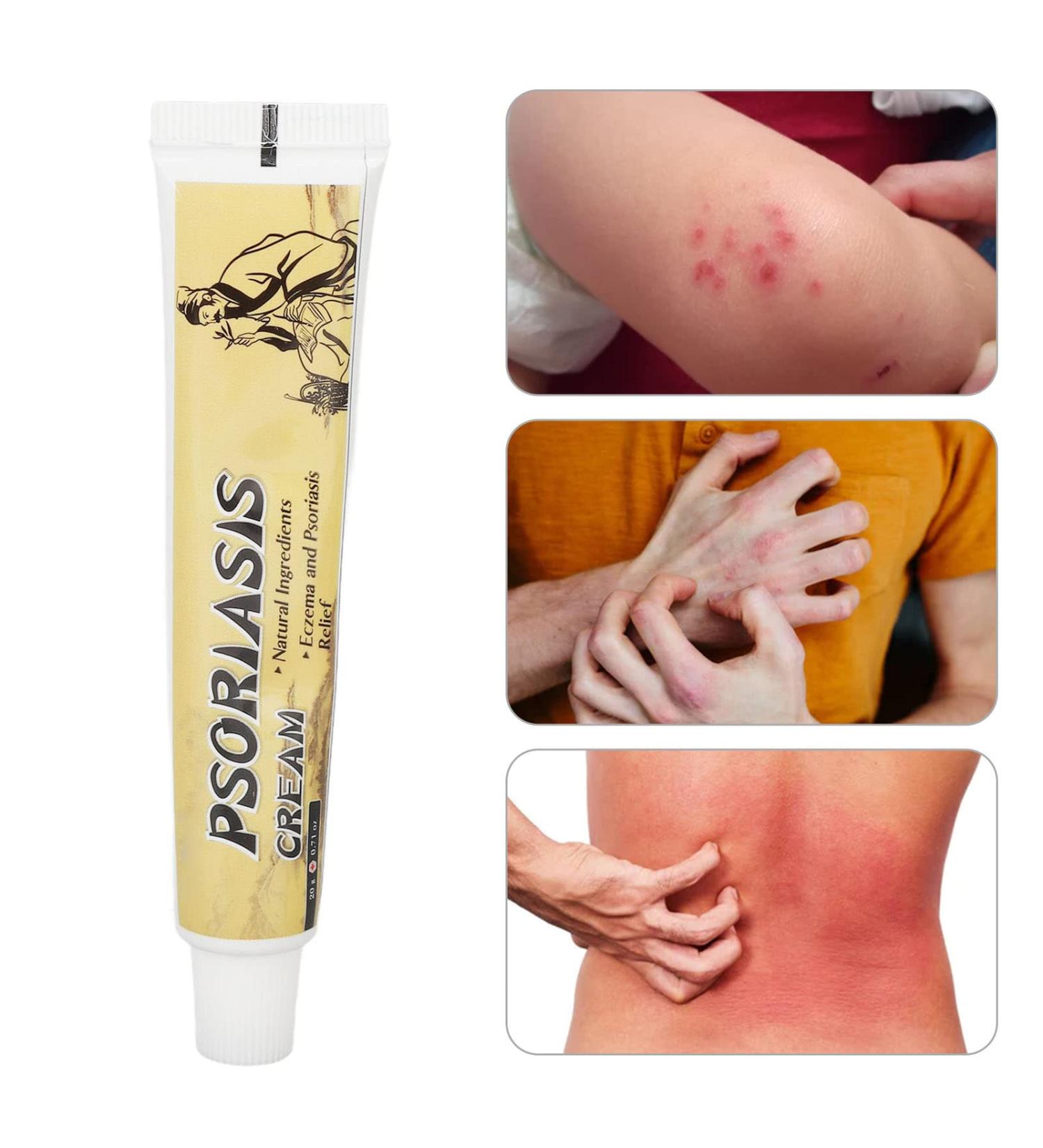 Buy Psoriasis & Eczema Creams | Natural Herbal Moisture Creams & Anti-Itching Solutions - Buy Online on GoSupps.com