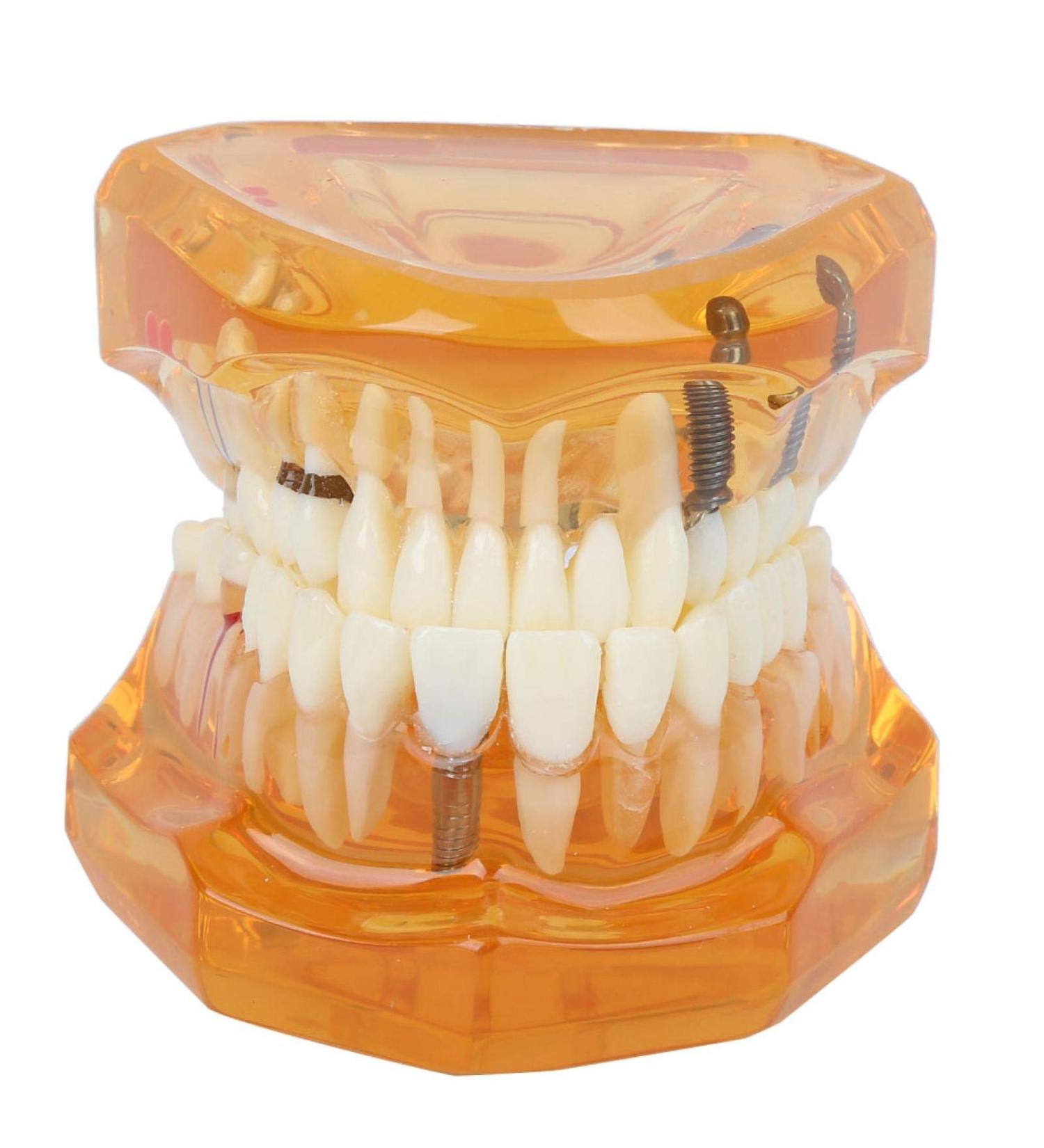 Dpofirs Orange Dental Model - Removable Teaching Tool for Dental Programs Adult Tooth Demonstration & Dental Implants - Buy Online on GoSupps.com