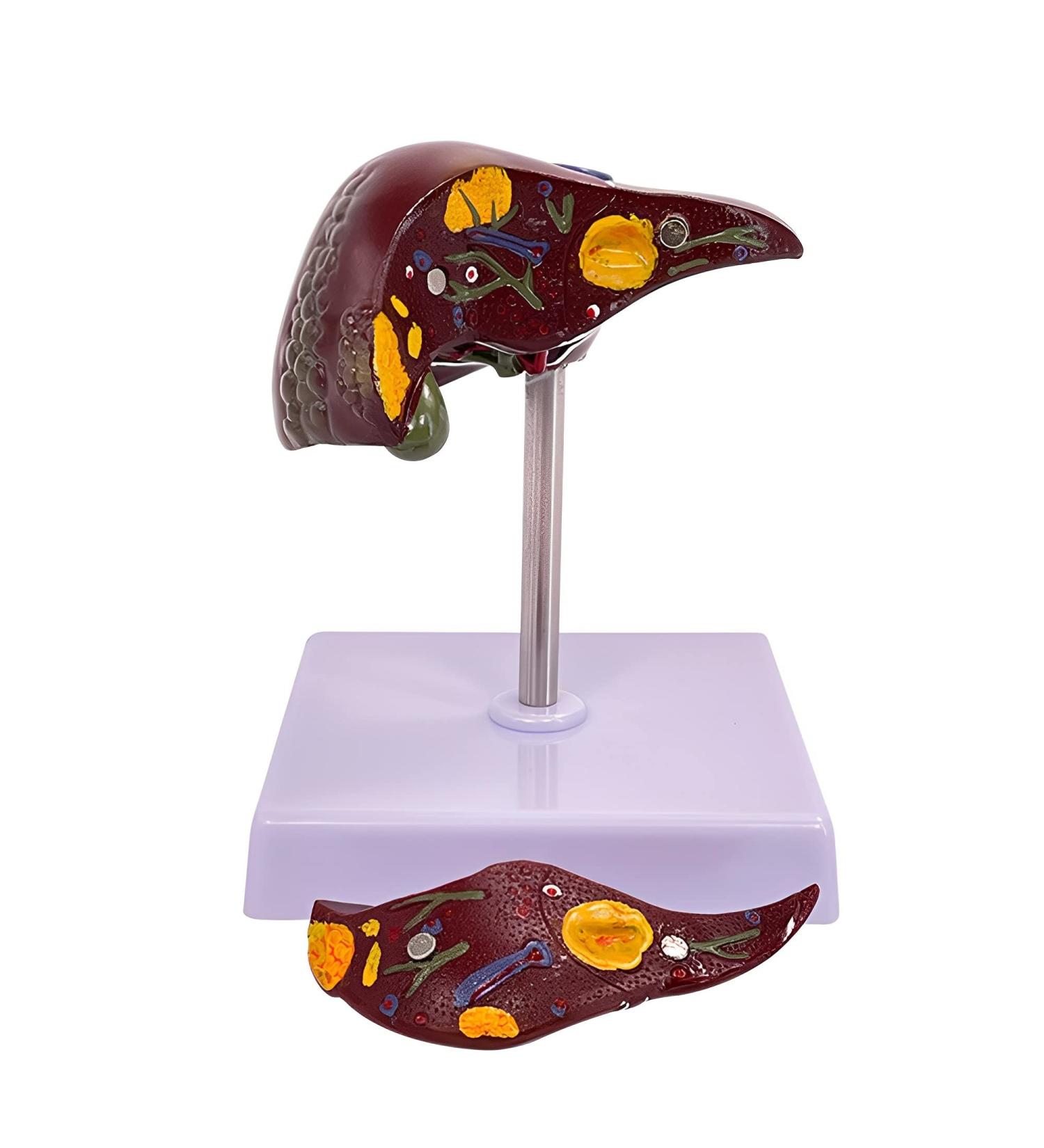 ARAZI Human Liver Pathology Model Visualization of Liver Lesions Clear Details Medical Teaching Props for Doctor-Patient Communication - Buy Online on GoSupps.com
