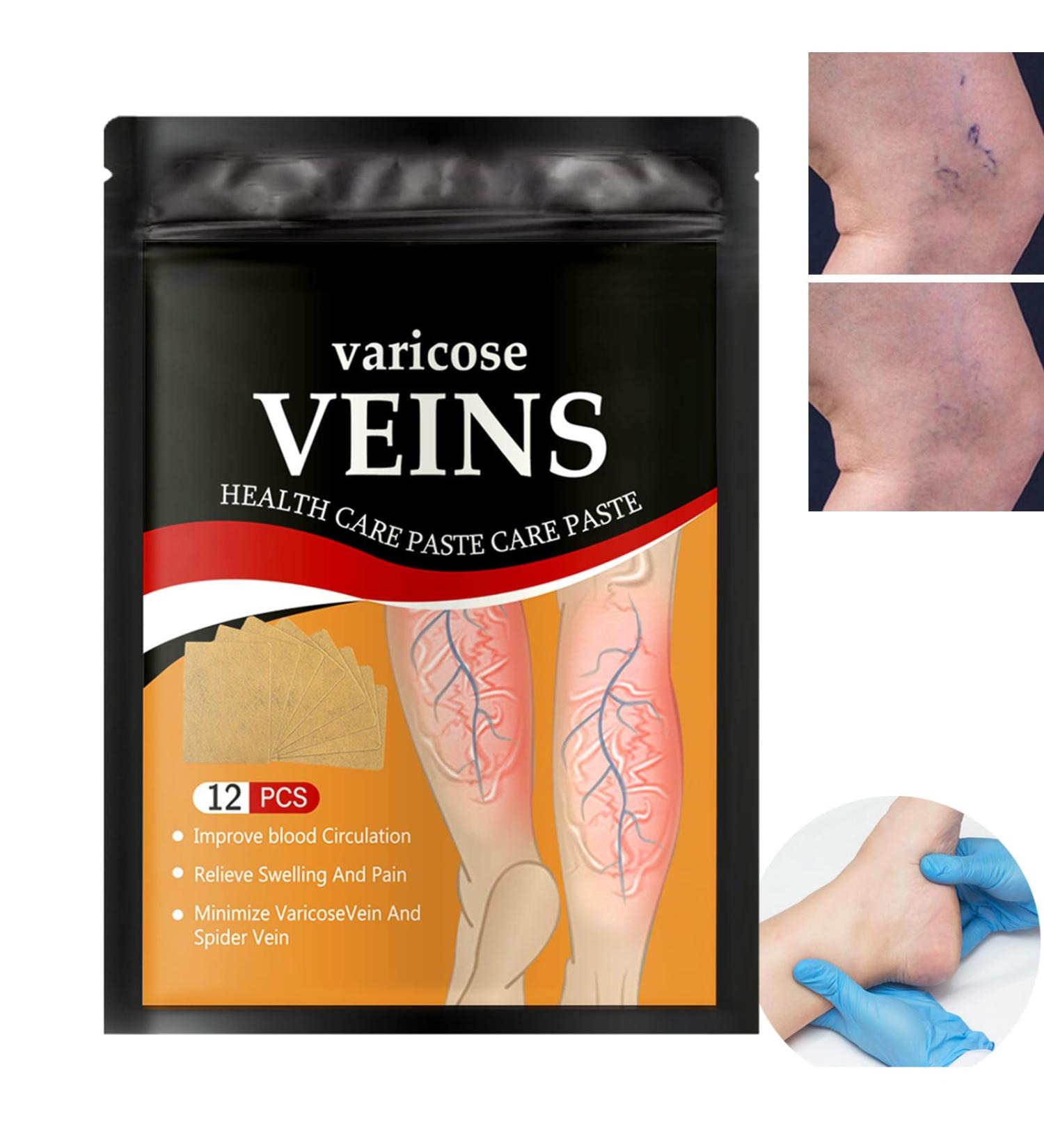 Patchs pour Varices pour les Jambes Patch Traitement Varices Patch de R paration des Varices Contre les Varices Patch Patchs Traitement de la Veine Araign e Jambe Soulager Gonflement Patch - Buy Online on GoSupps.com