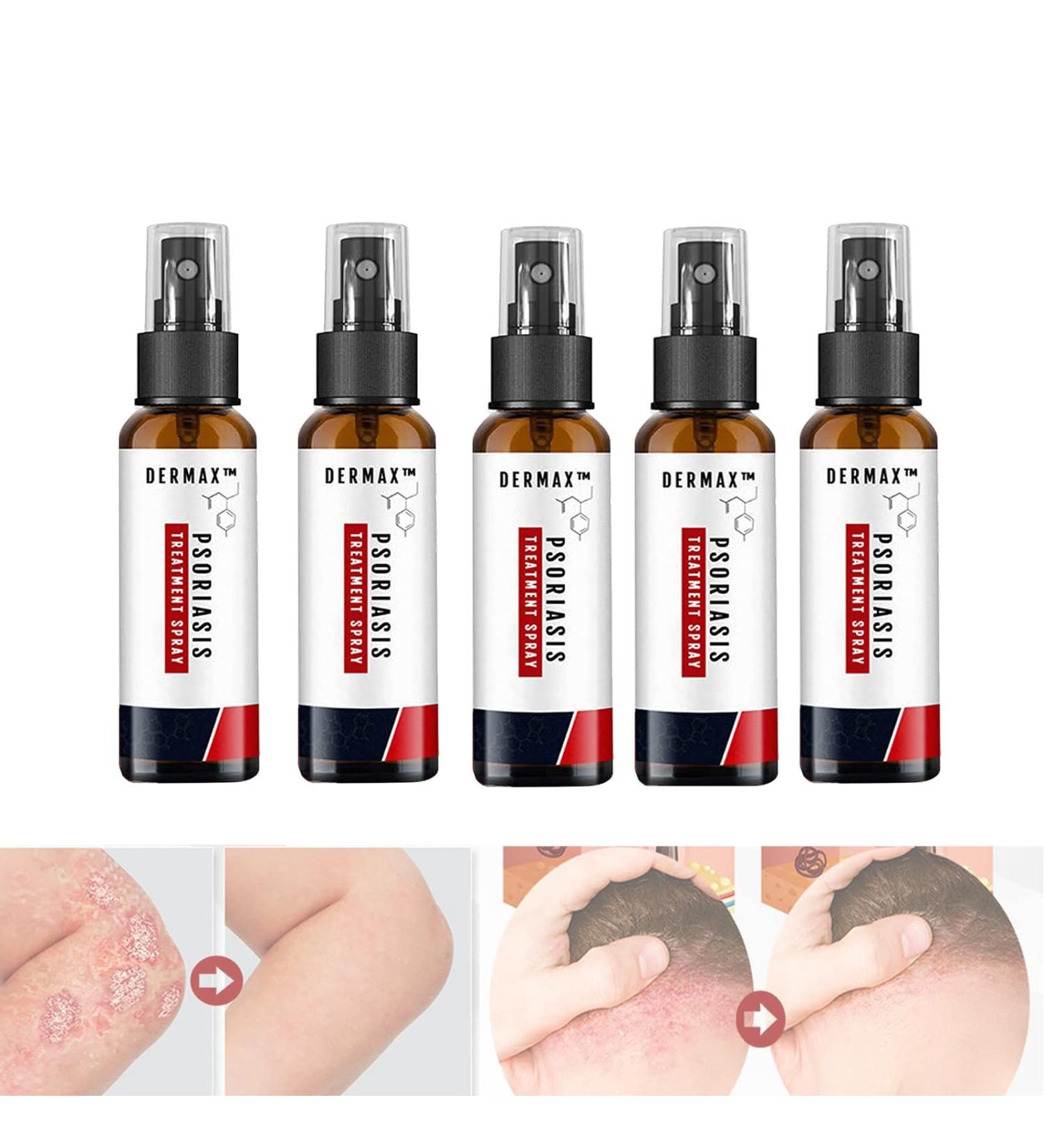 LELEBEAR Dermax Psoriasis Treatment Spray - Soothes Skin, Stops Burning and Itching (5 Pack) - Buy Online on GoSupps.com
