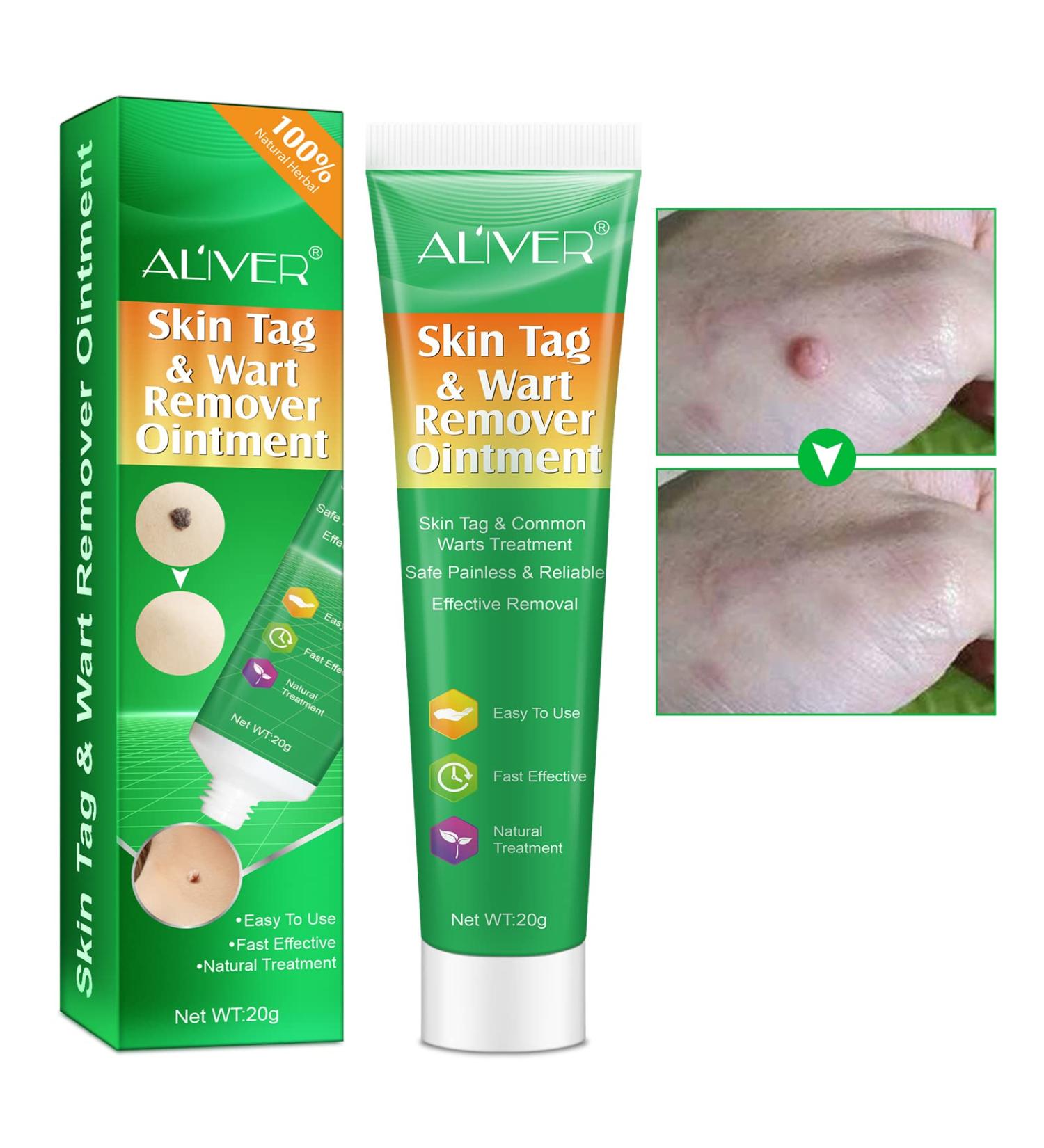 Skin Tag & Wart Remover Cream - Advanced Treatment Formula, Natural Ingredients - 20g - Buy Online on GoSupps.com