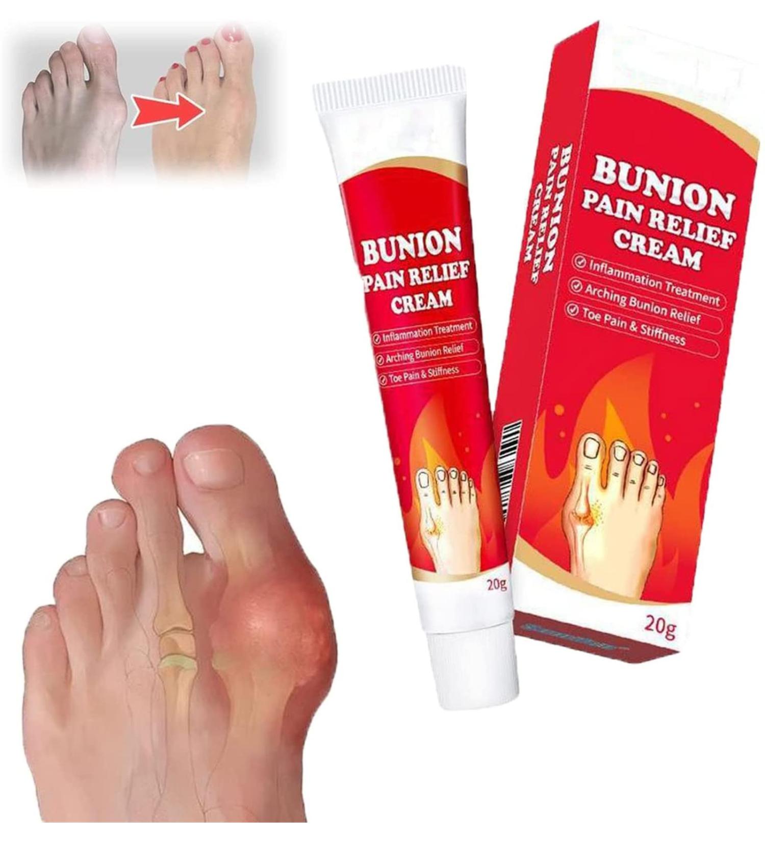 Arching Bunion Relief Cream | Topical Ointment for Arthritis & Joint Pain | Effective Bunion Pain Relief (1PC) - Buy Online on GoSupps.com