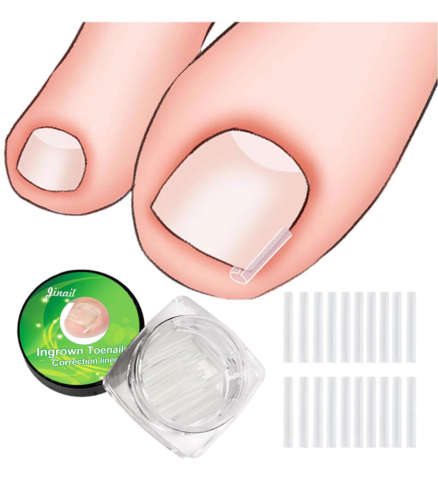 RMISODO 60-Piece Ingrown Toenail Corrector Strips - Professional Toenail Correction Patches for Curved Toenails - Paronychia Correction Pedicure Tool - Buy Online on GoSupps.com