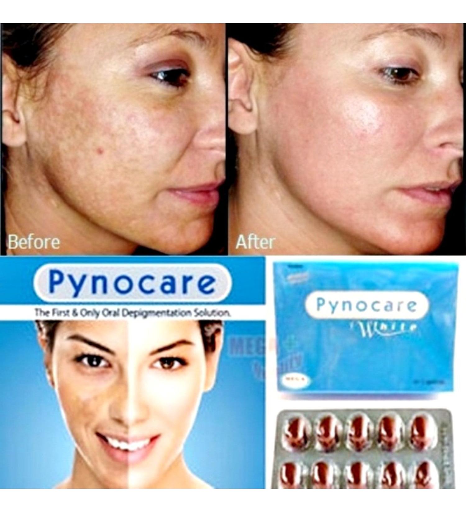 4 PACK(80 CAPSULES) OF PYNOCARE 100% HERBAL WHITENIN ANTI MELASMA HYPERPIGMENTATION SUN DAMAGE DARK SPOT