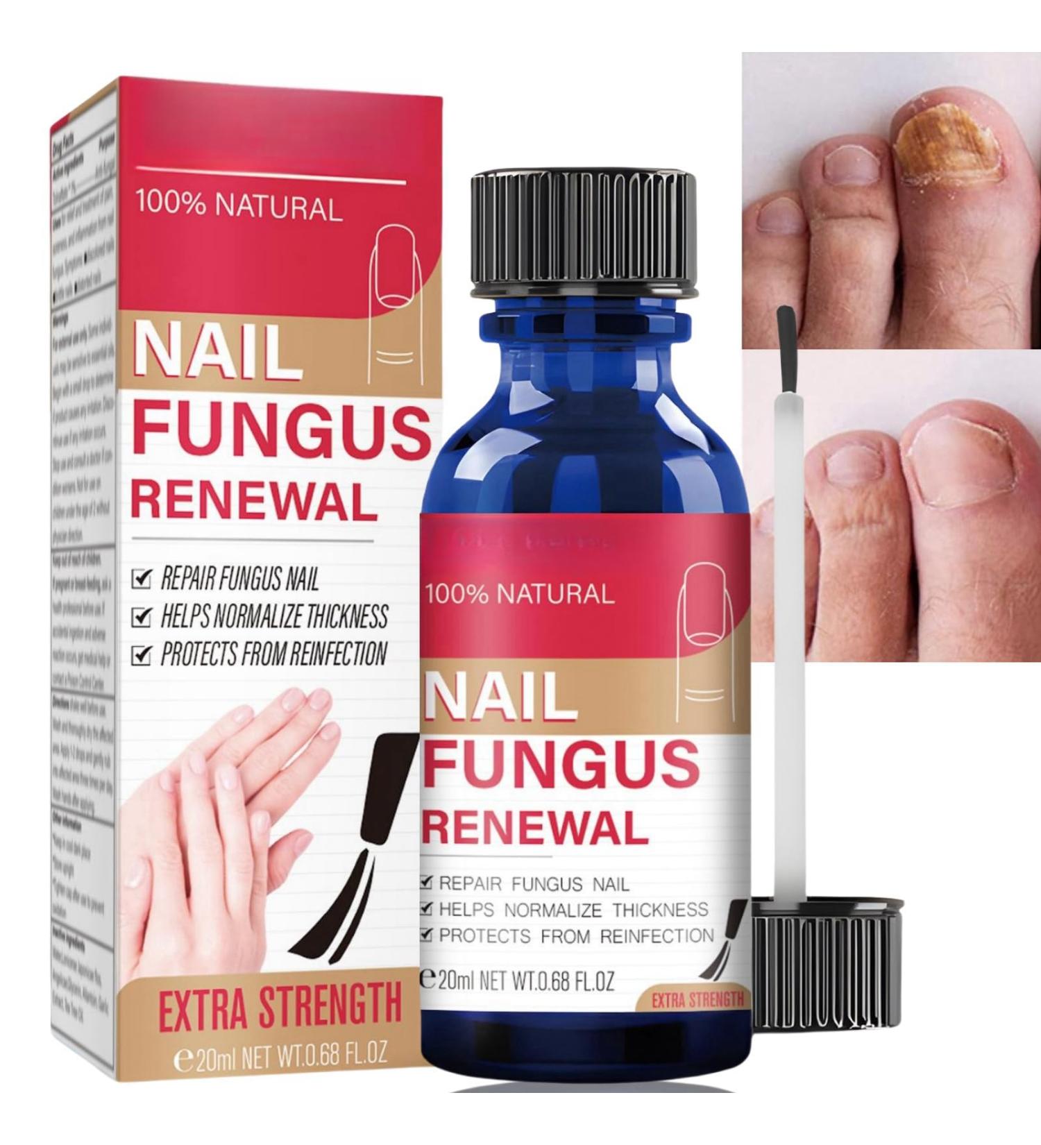 20ml Fungal Nail Treatment Serum Nail Strengthener for Damaged Nails Extra Strong Nail Fungus Treatment for Toenail and Fingernail Nail Polish Anti-Fungus Nail Repair and Strengthen Nail Repair Care - Buy Online on GoSupps.com
