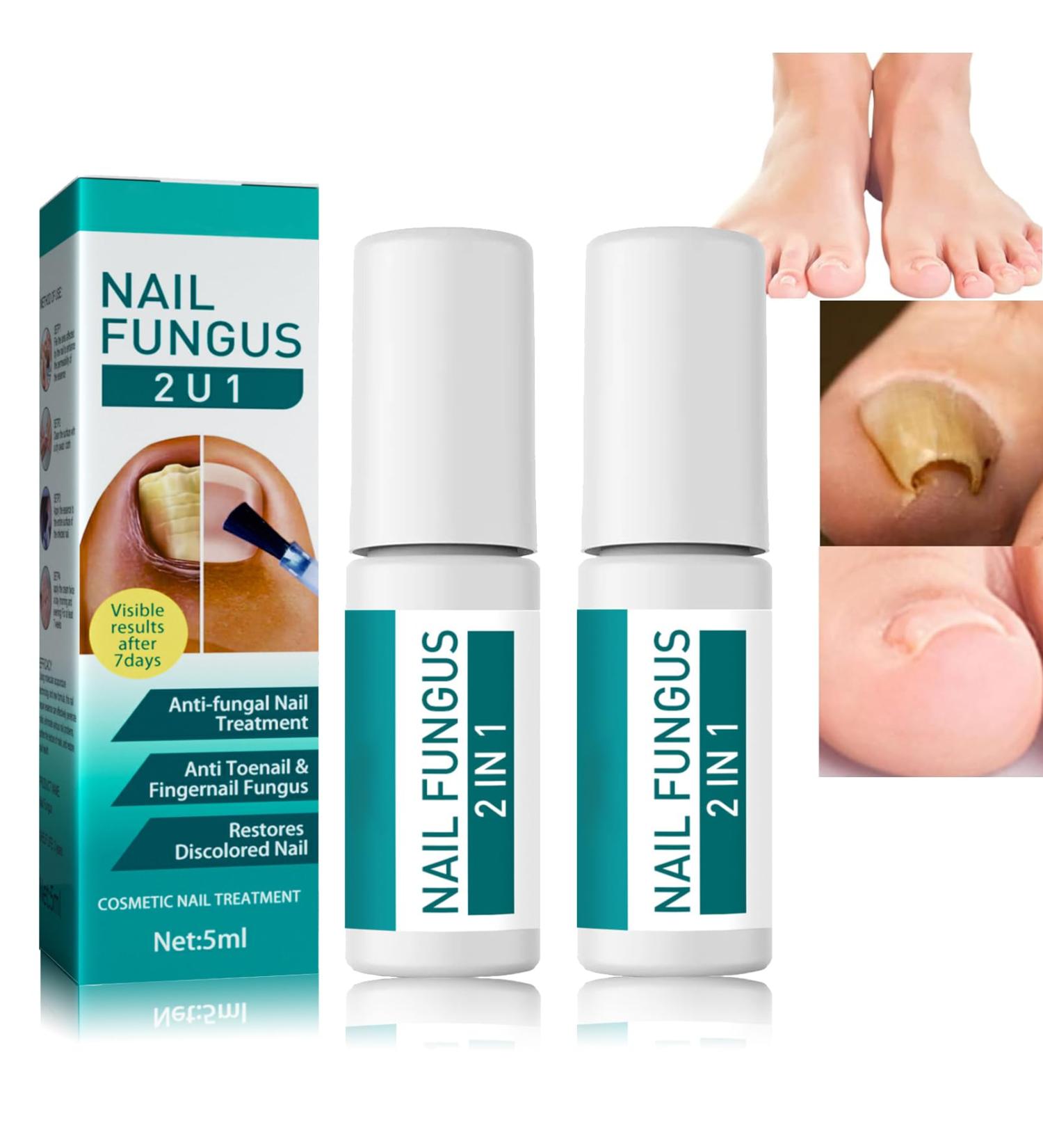 Fungal Nail Treatment - Extra Strong Anti-Fungal Solution for Toenails - Natural Nail Fungus Treatment for Finger & Toe Nails - 2 IN 1 X 2pcs - Buy Online on GoSupps.com