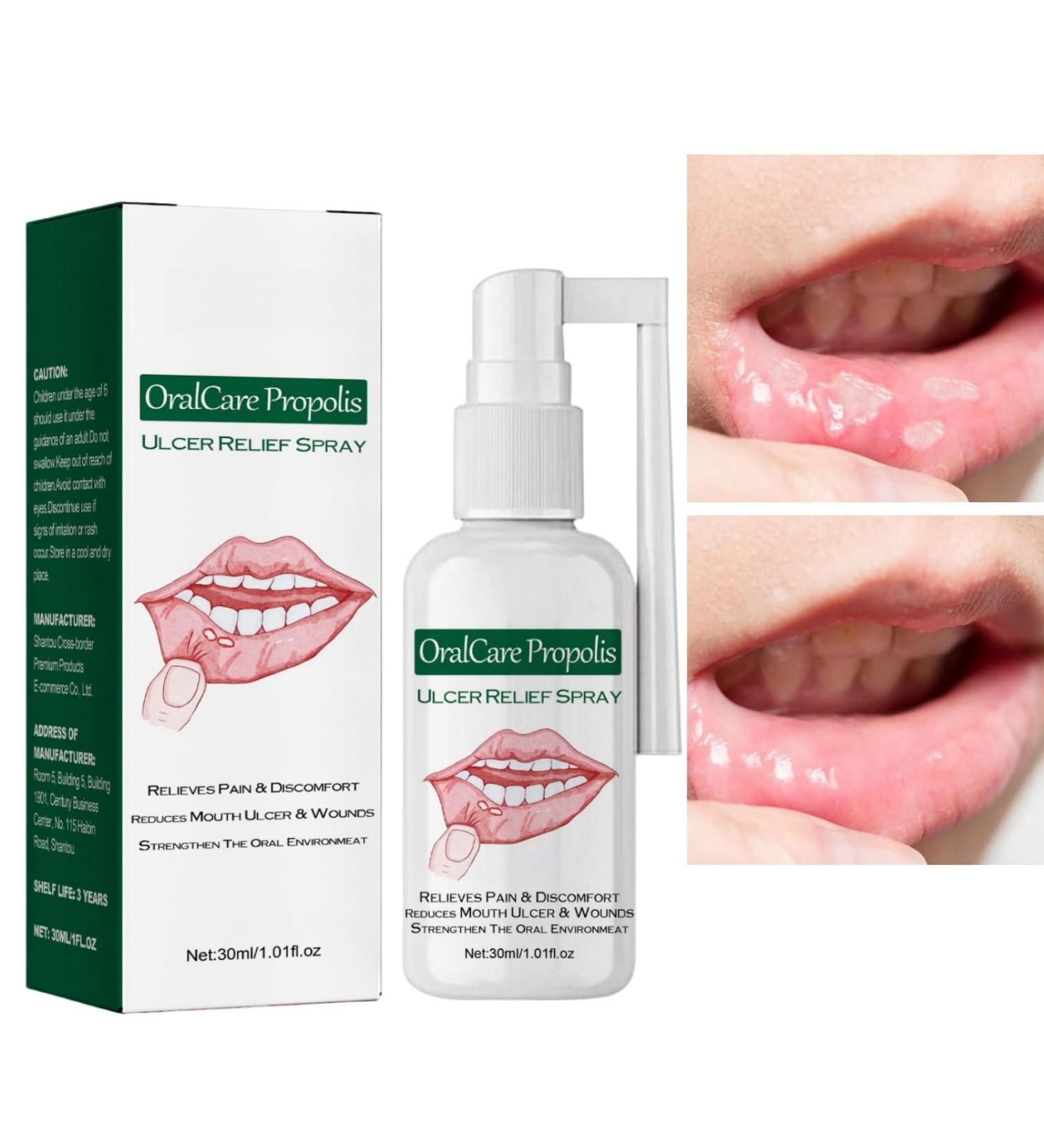 Mouth Ulcer Treatment Spray Mouth Ulcer Spray Canker Sore Treatment for Adults Oralcare Propolis Ulcer Relief Spray Herbal Mouth Spray Canker Relief Spray Breath Spray for Bad Breath Breath Freshener - Buy Online on GoSupps.com