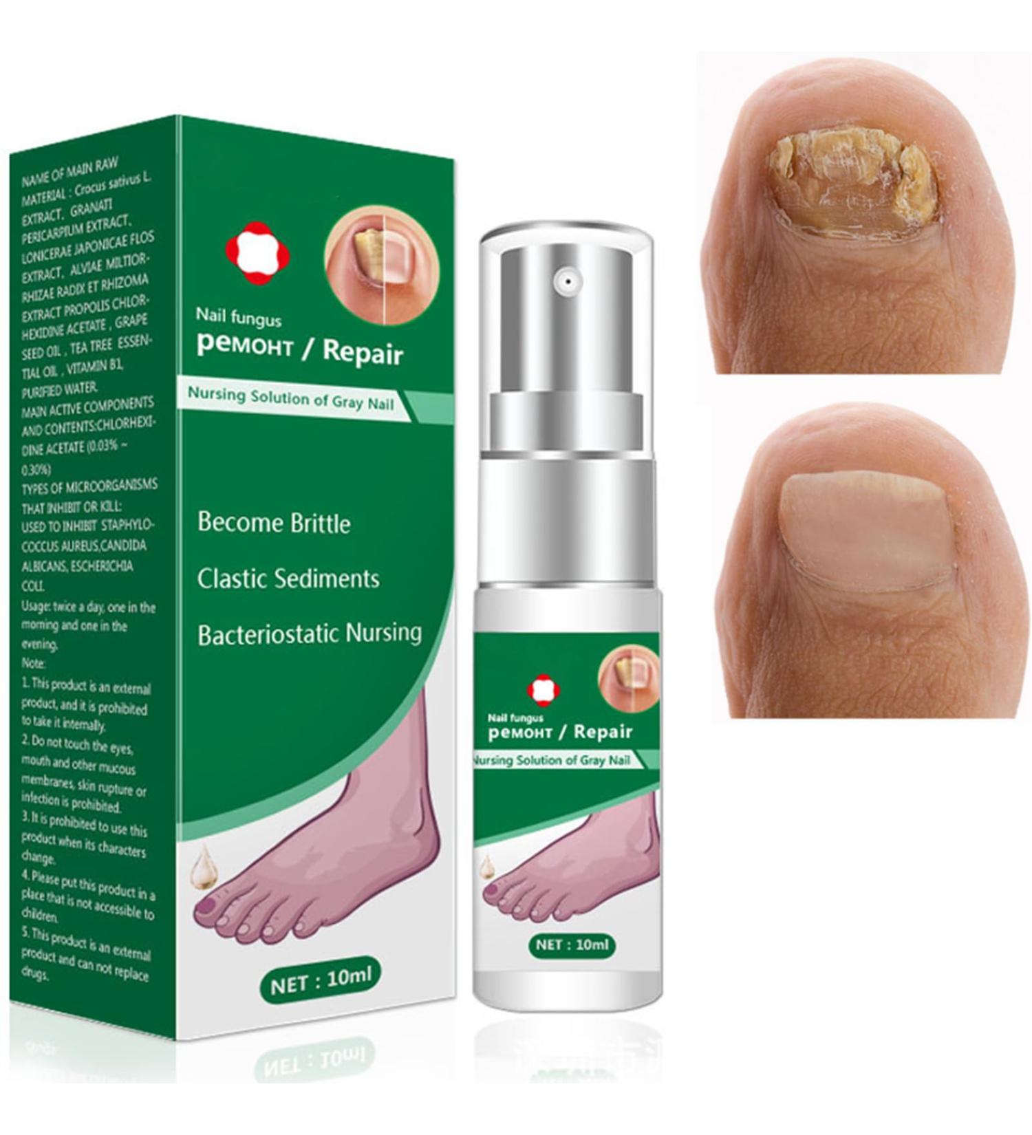 Nail Fungal Treatment Spray - Advanced Toenail & Nail Strengthener Repair - 10ml - Buy Online on GoSupps.com